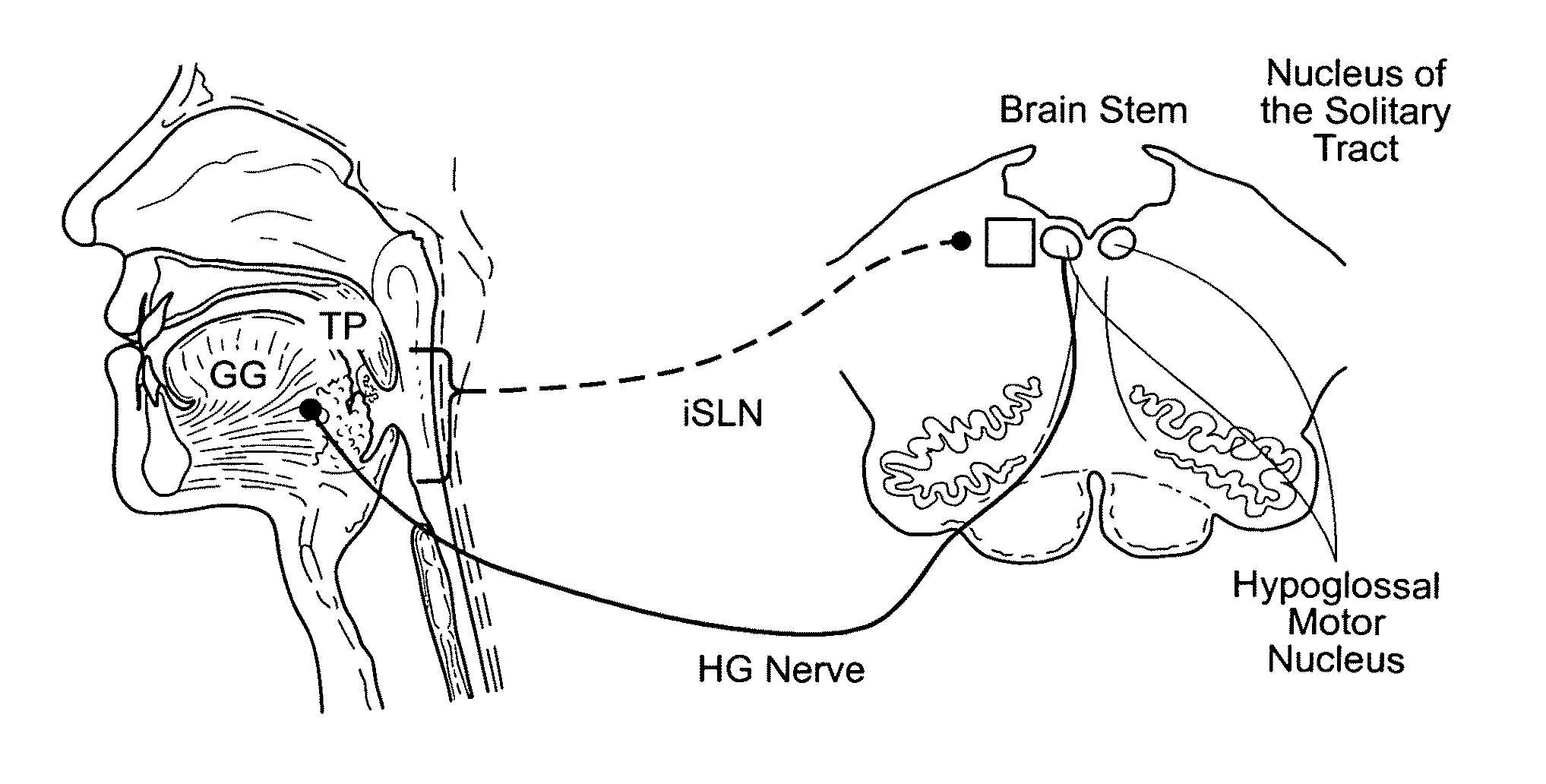 Systems and methods for maintaining airway patency