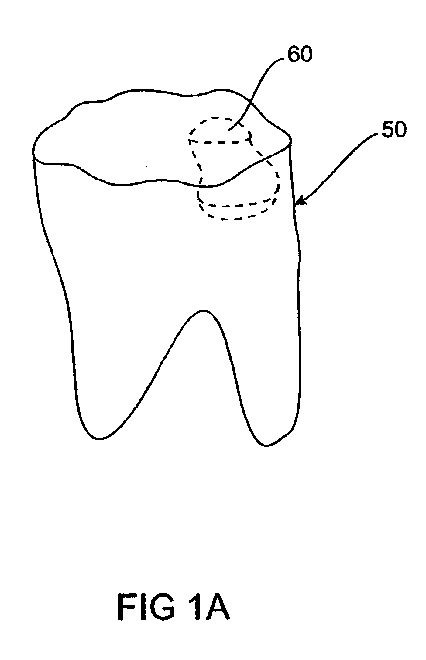 Method and system for selectively staining dental composite resin