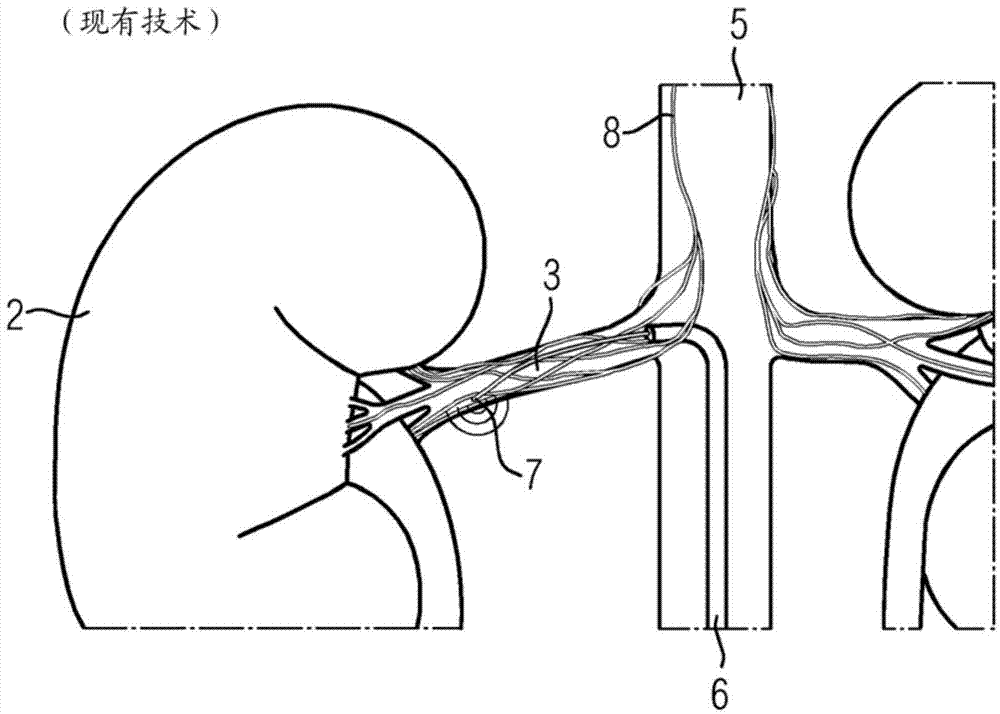 Method and device for determining a damage characteristic value of a kidney