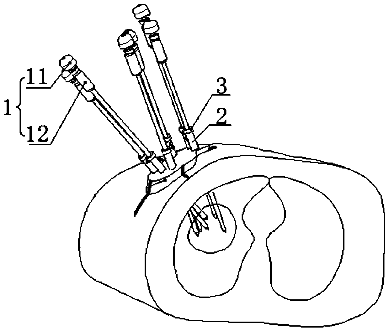 Image-lead after-loading interposition arthroplasty treatment system