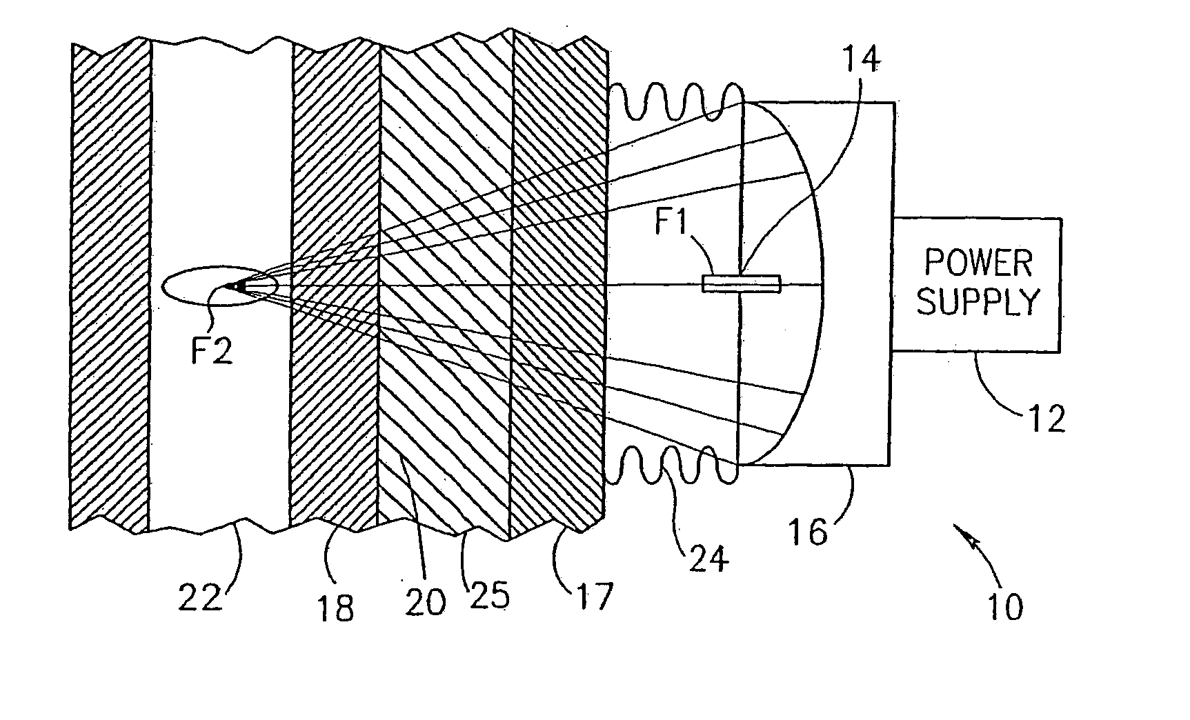 Pressure-pulse therapy device for treatment of deposits
