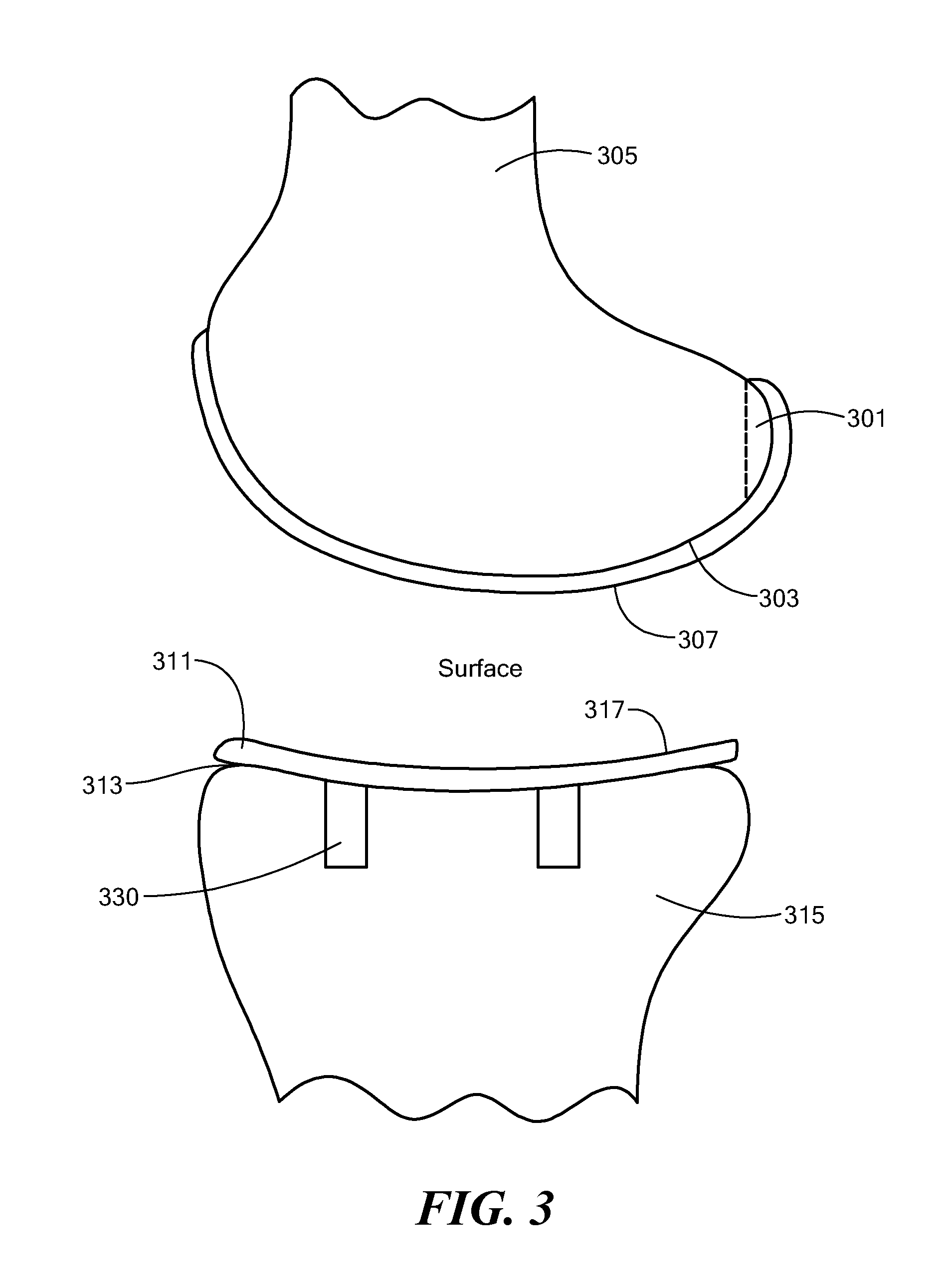 Implant device and method for manufacture