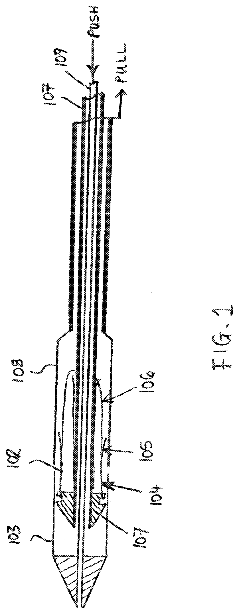 Systems, methods and devices for retrograde pericardial release of a prosthetic heart valve