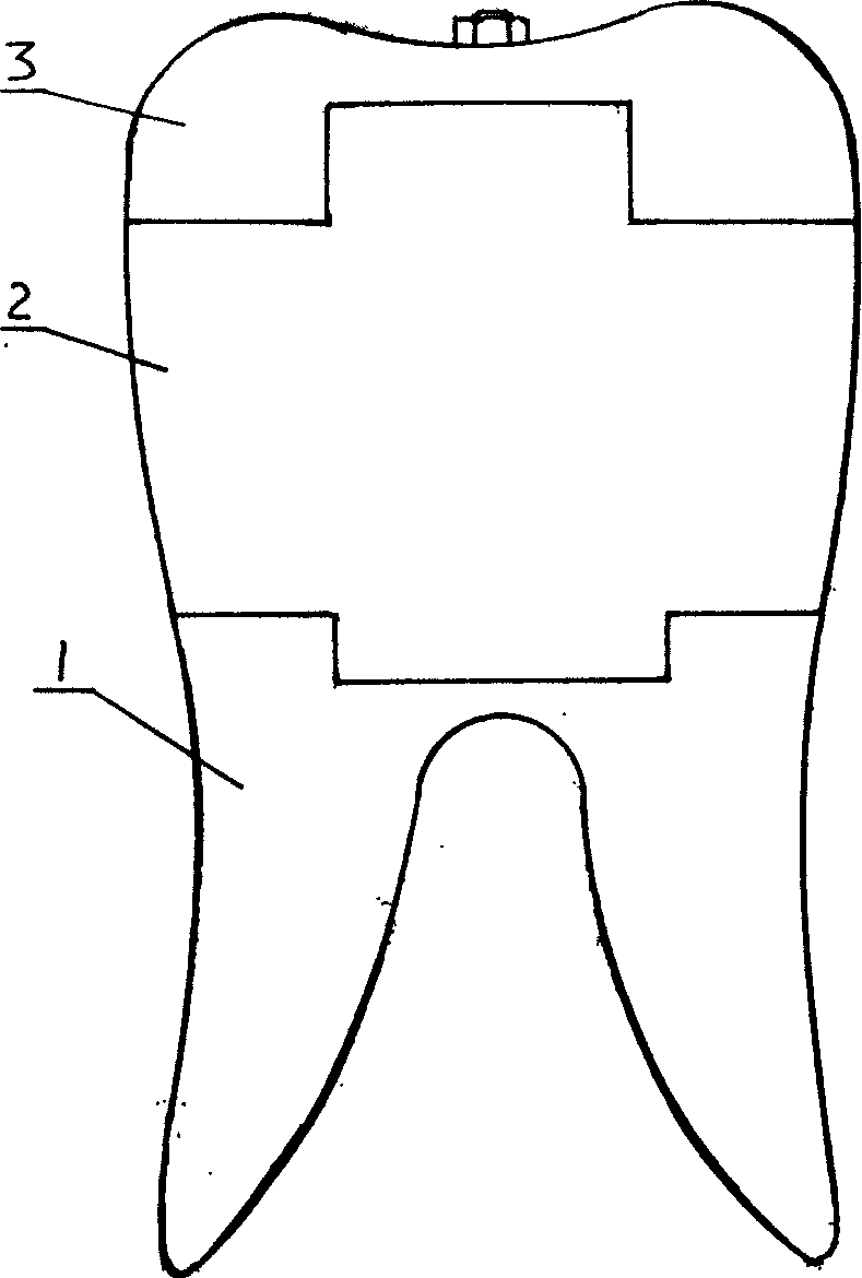 Suspending dental crown type implanting tooth