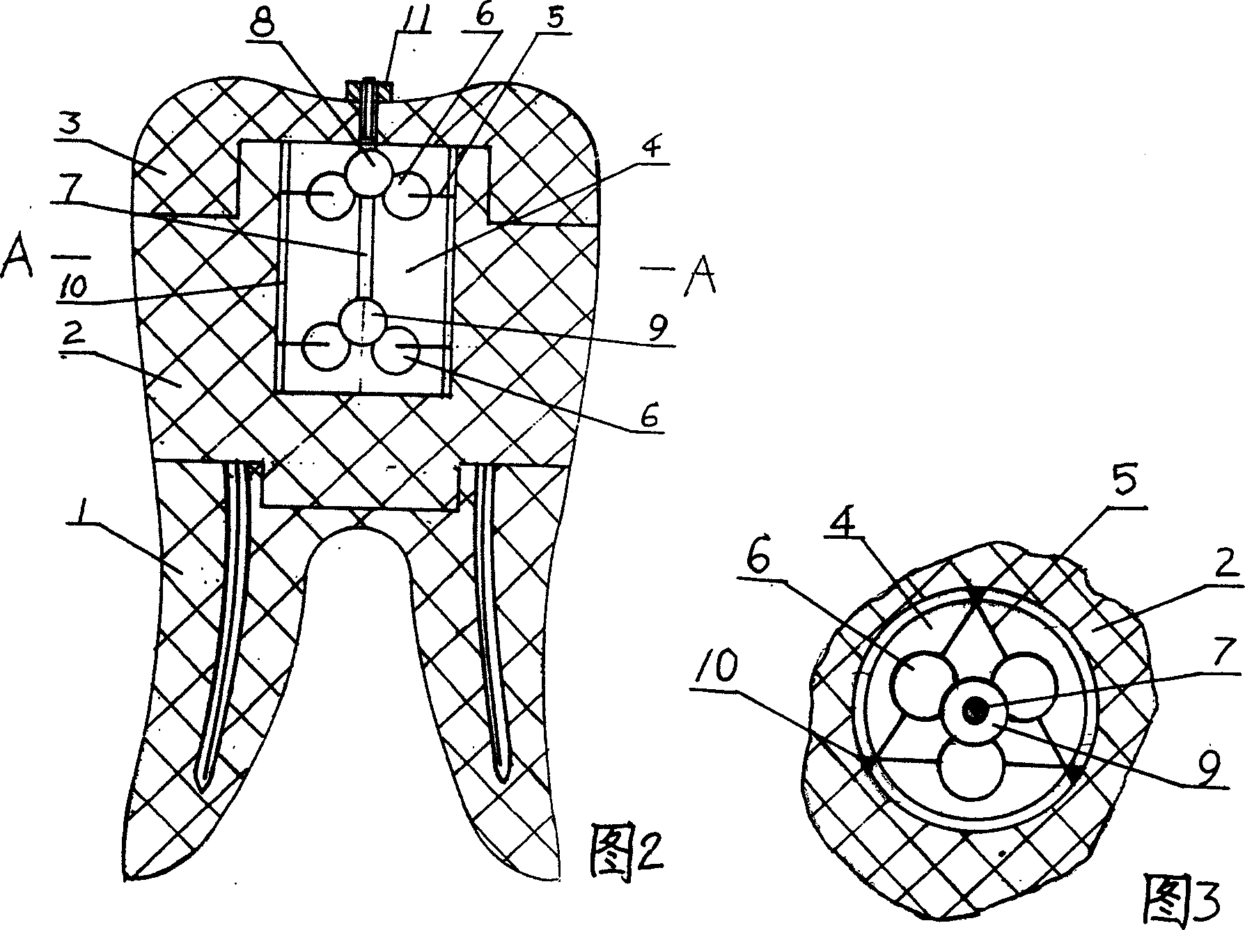 Suspending dental crown type implanting tooth