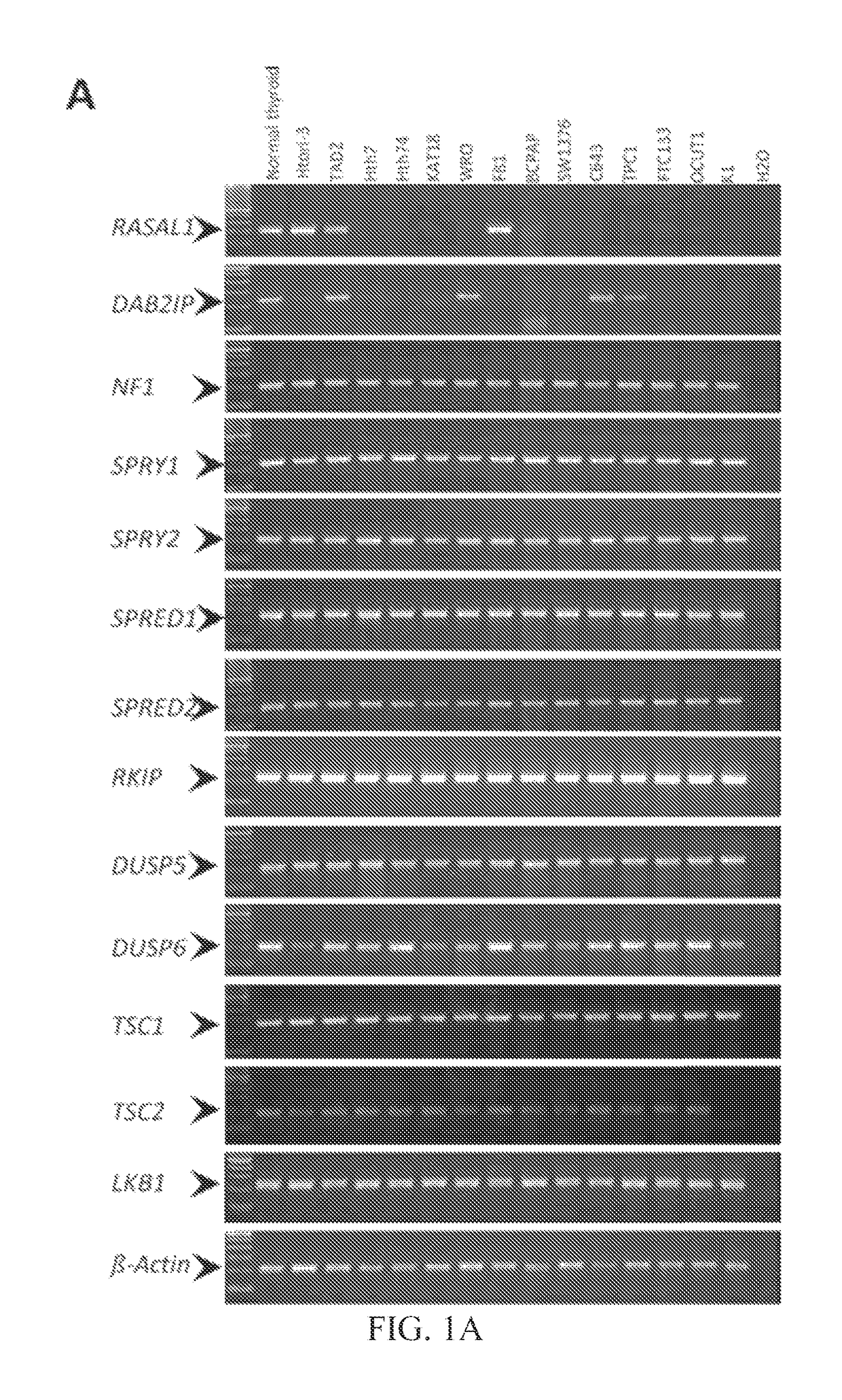 RASAL1 is a major tumor suppressor gene in thyroid cancer