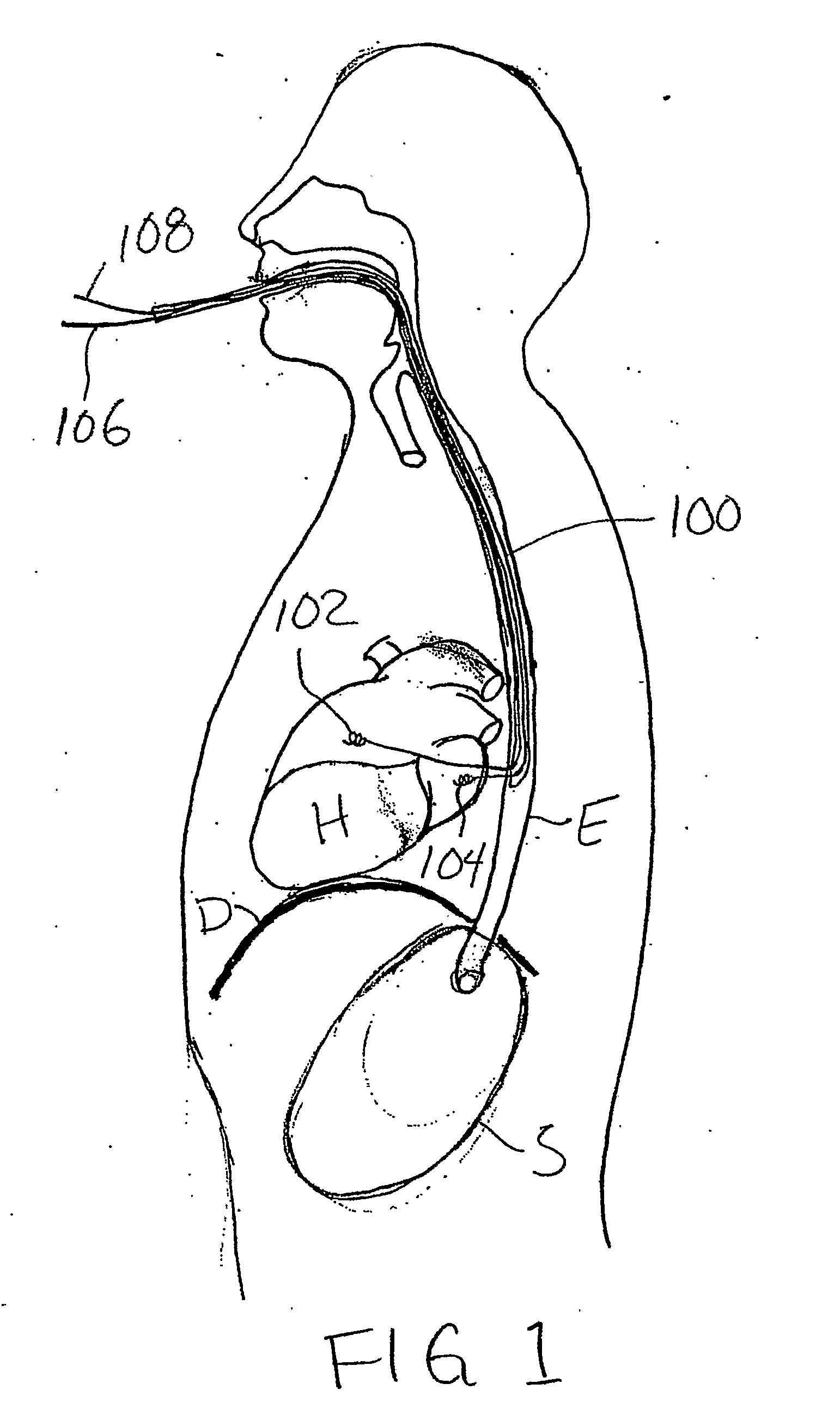 Transesophageal implantation of cardiac electrodes and delivery of cardiac therapies