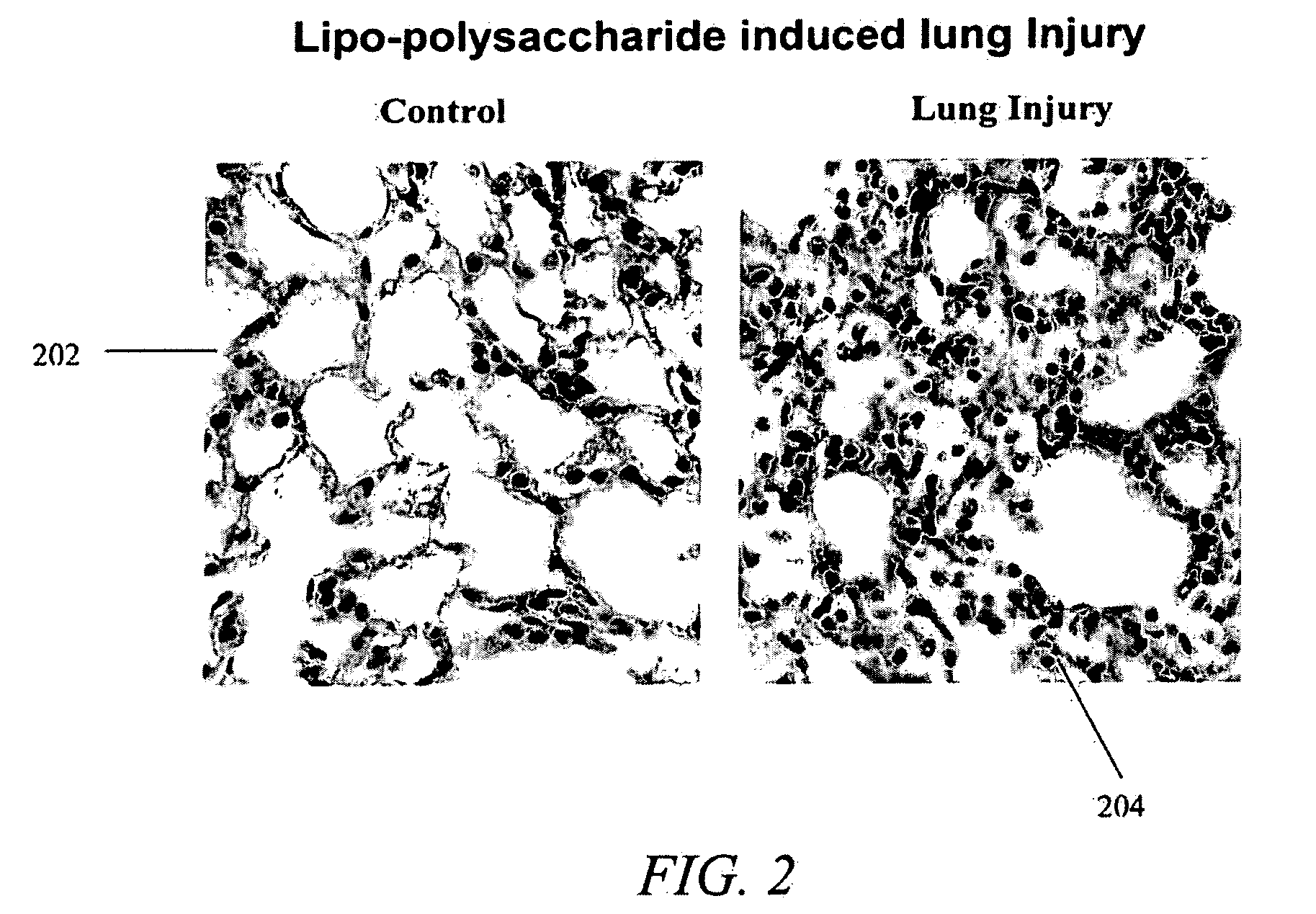 Lung Injury Treatment