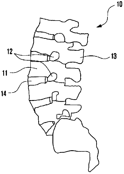 Interspinous support and method for fixing same