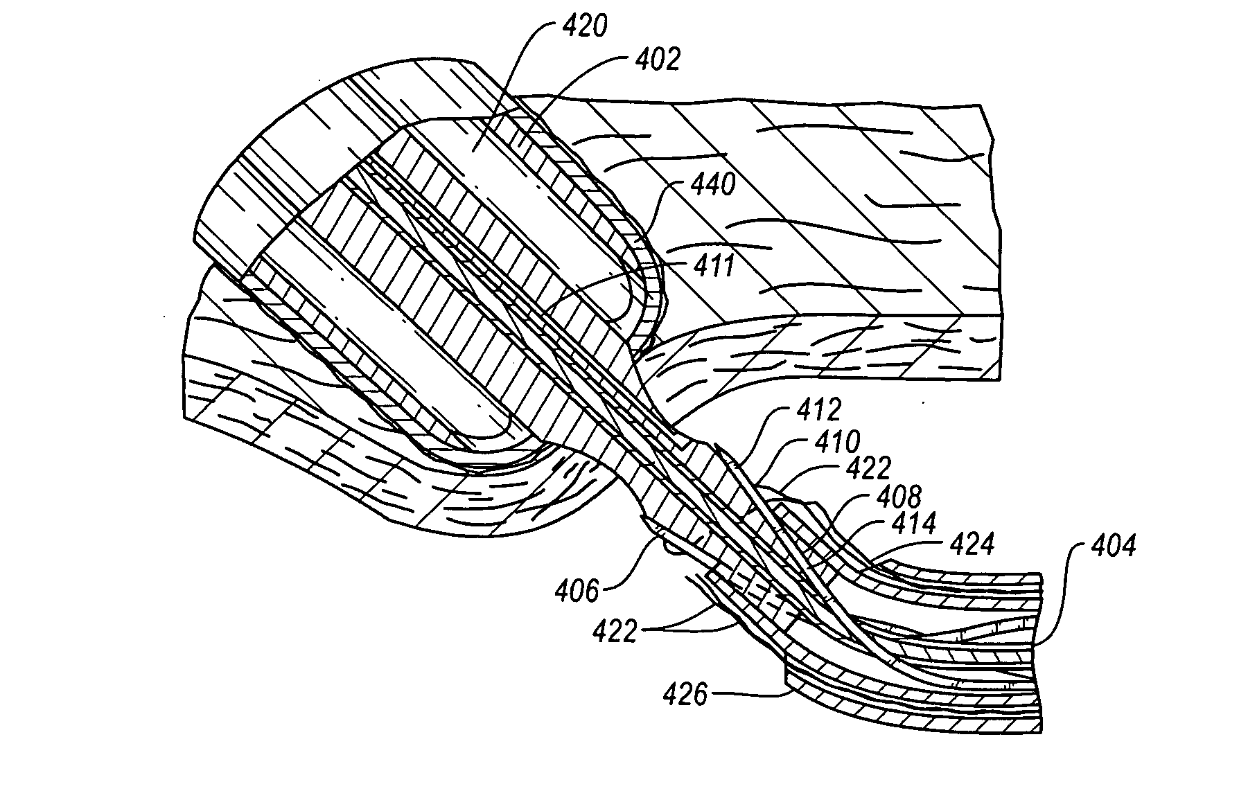 Device and Methods for Suturing Tissue