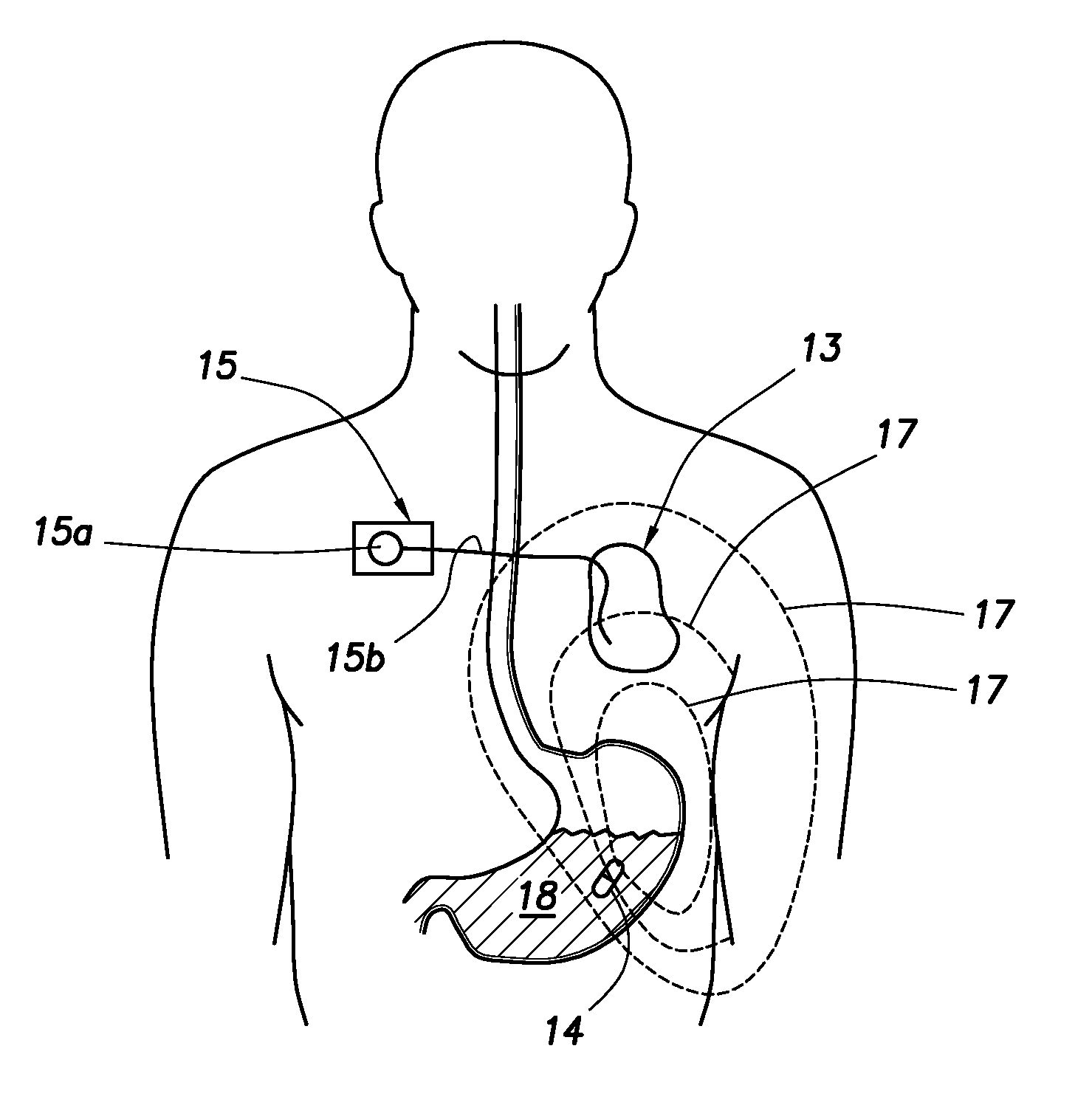 Communication System Using an Implantable Device