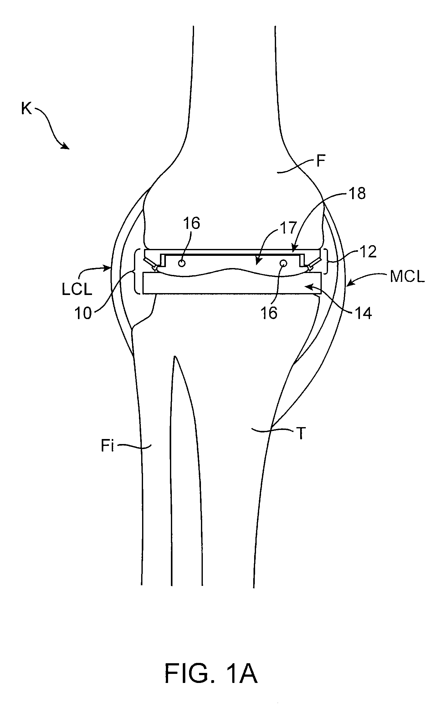 Dynamic knee balancer with pressure sensing