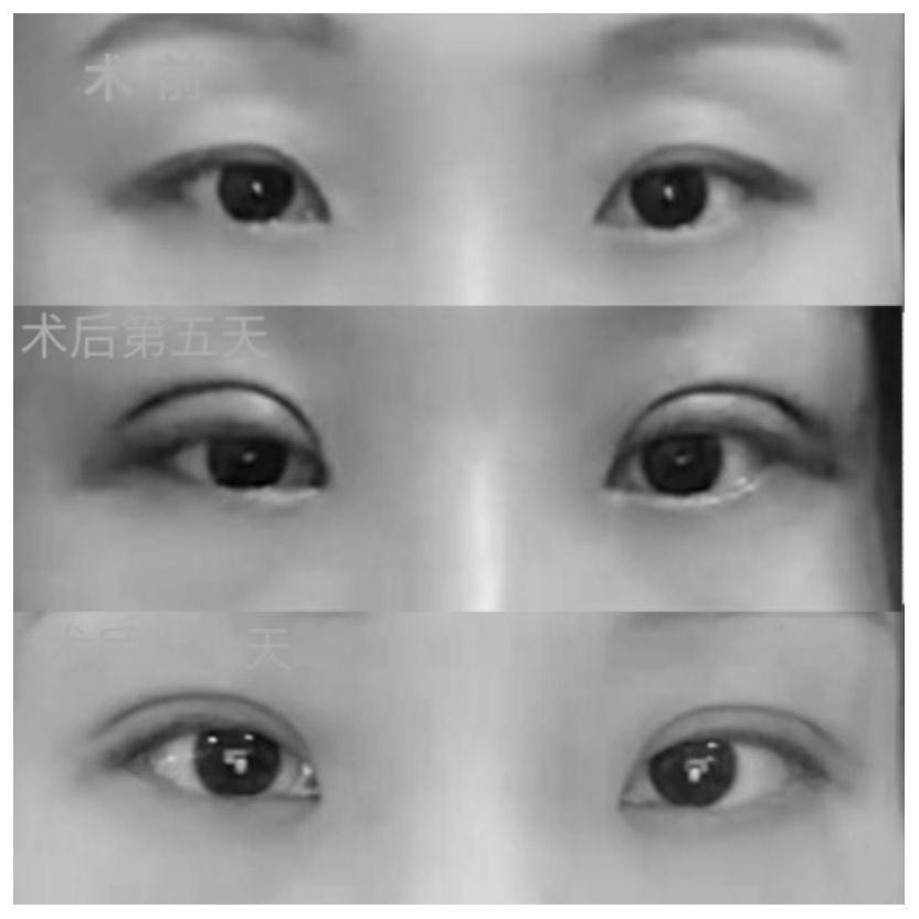 Eye plastic surgery evaluation method based on eyelid curvature graph