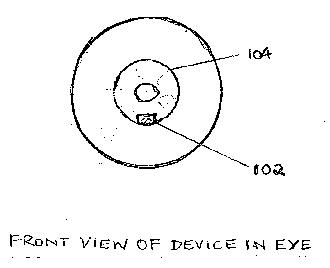 Device to directly monitor intra ocular pressure by a person based on pattern and colour changes