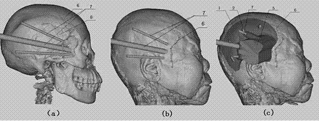 A percutaneous infratemporal fossa-outer orbital wall endoscopic puncture guide and its application method