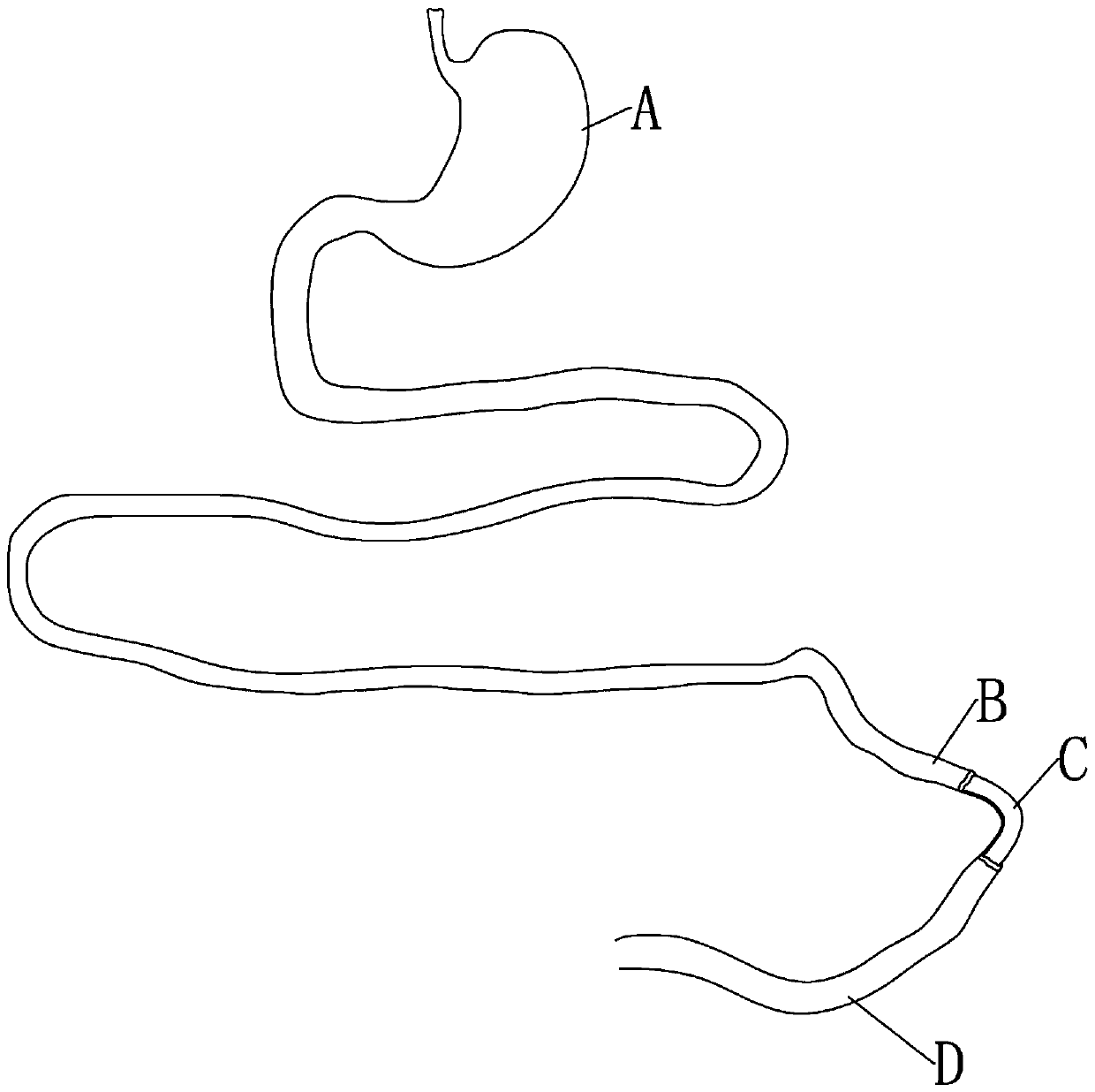 Intestinal content autologous reinfusion device and usage method after small bowel double-cavity ostomy