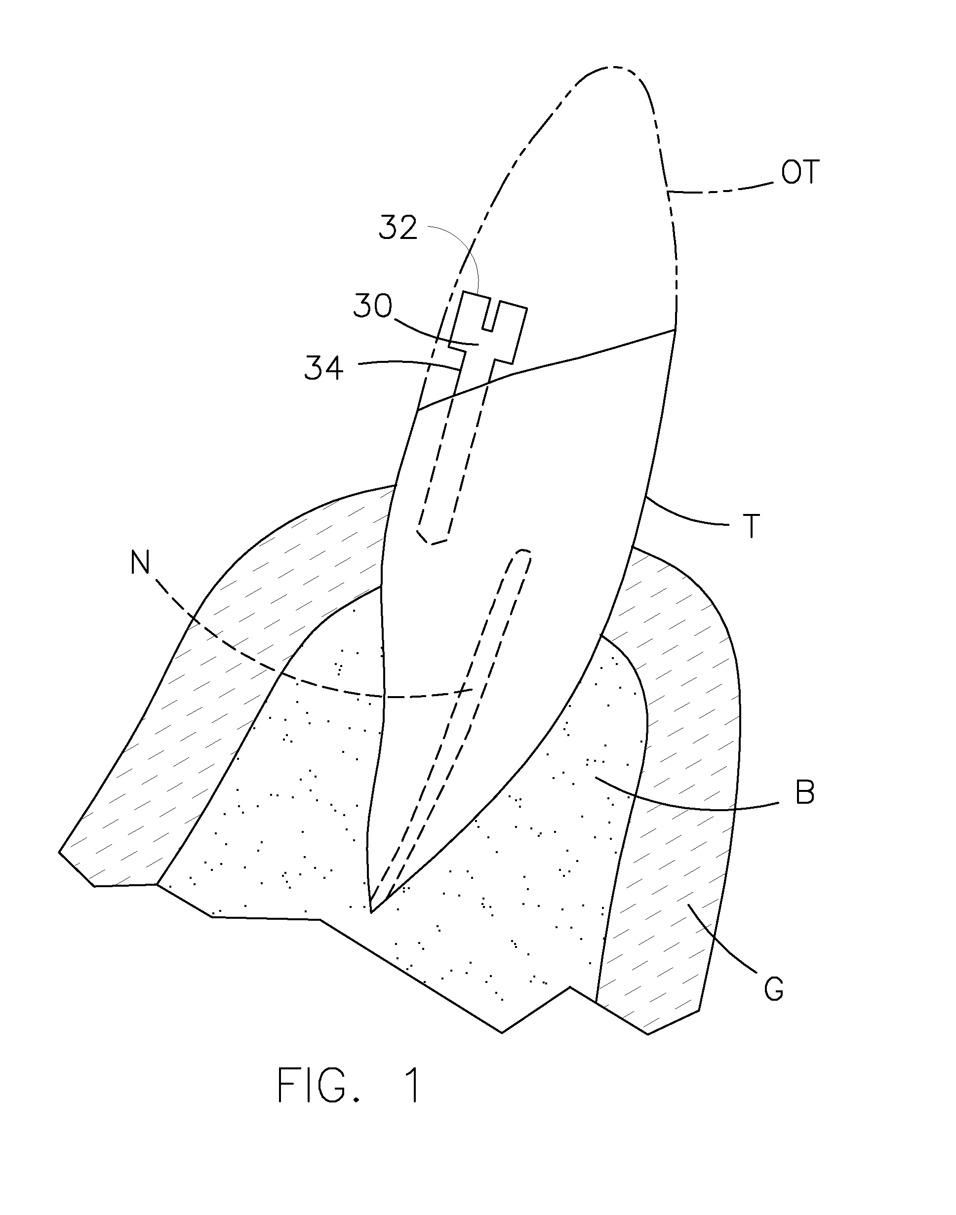 Dental prosthesis for cattle and method for mounting it