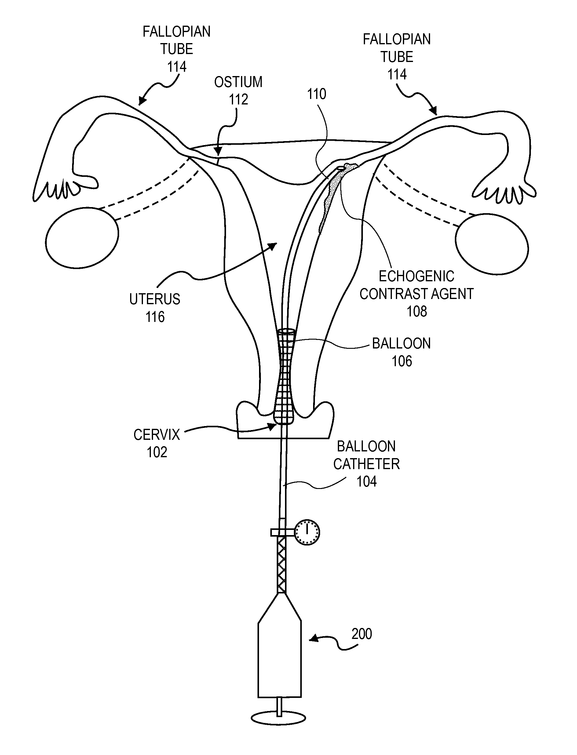Methods and devices for determining lumen occlusion