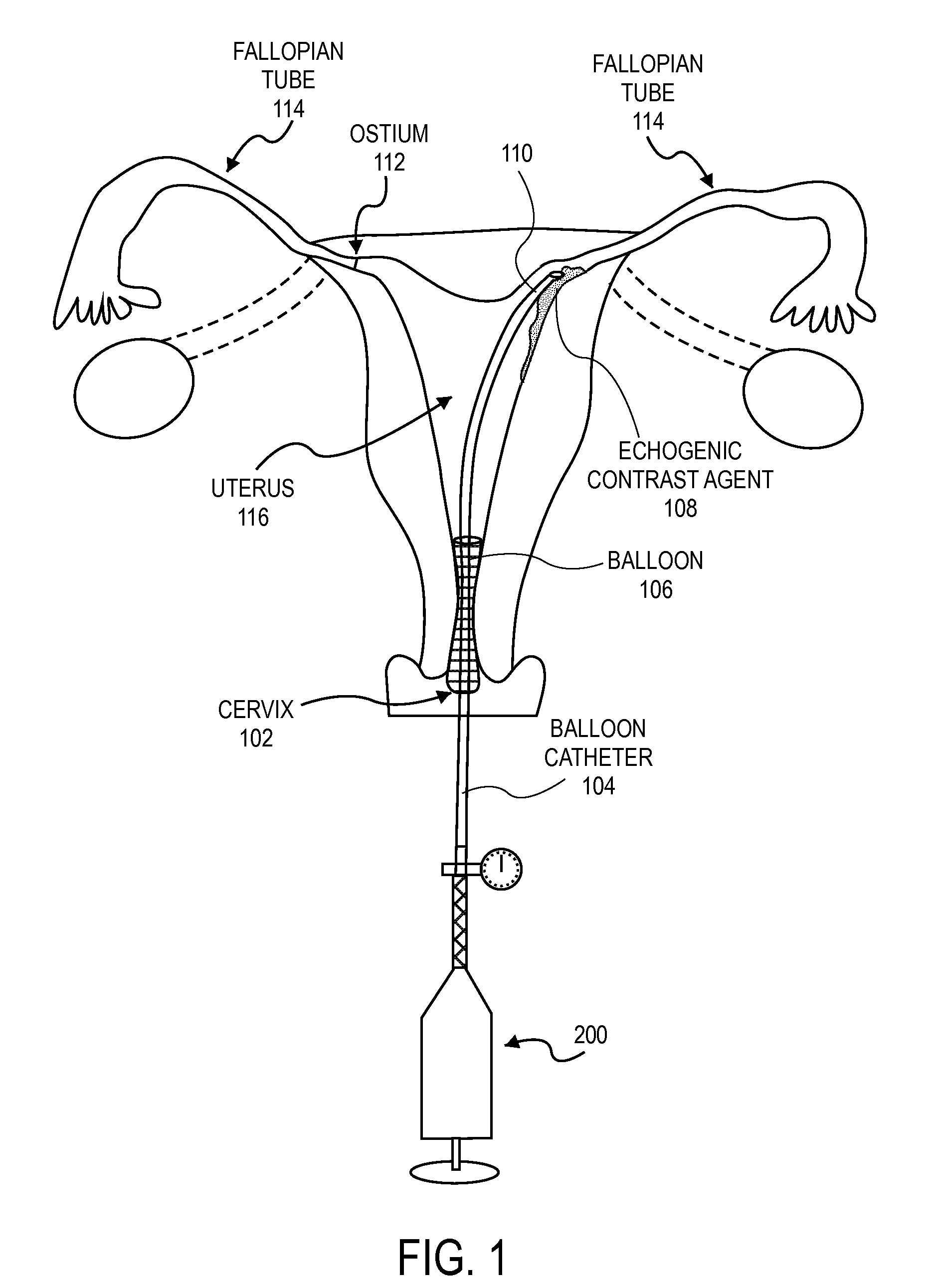 Methods and devices for determining lumen occlusion