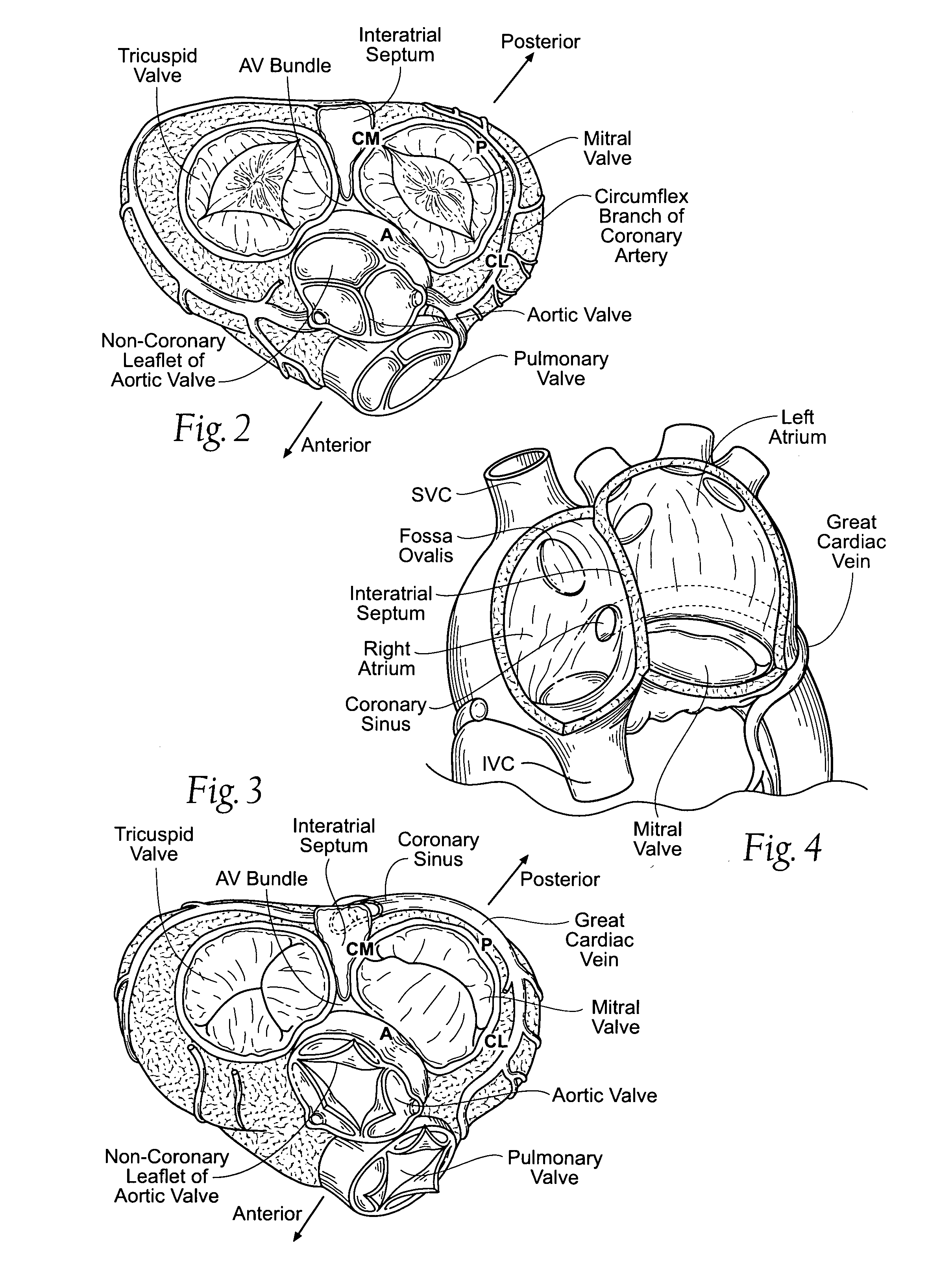 Devices, systems, and methods for reshaping a heart valve annulus, including the use of magnetic tools