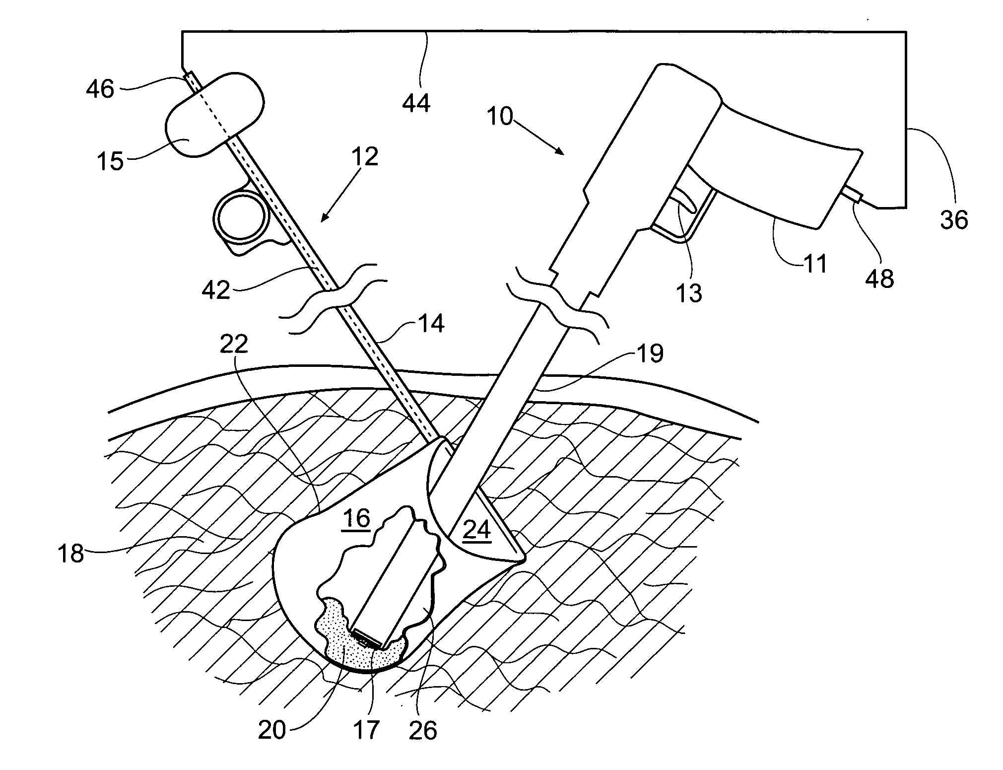 Surgical bag and morcellator system and method of use