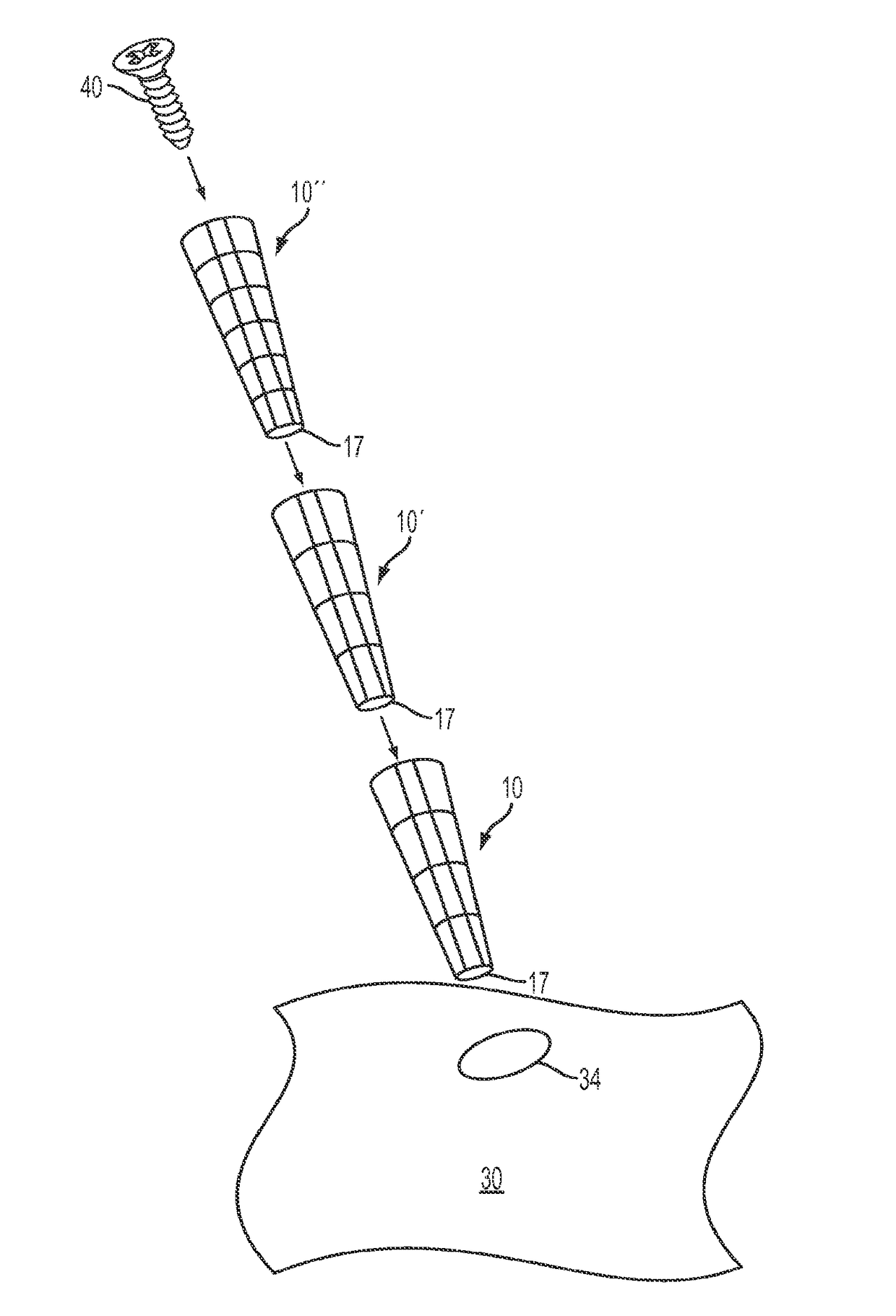 Surgical screw hole liner devices and related methods