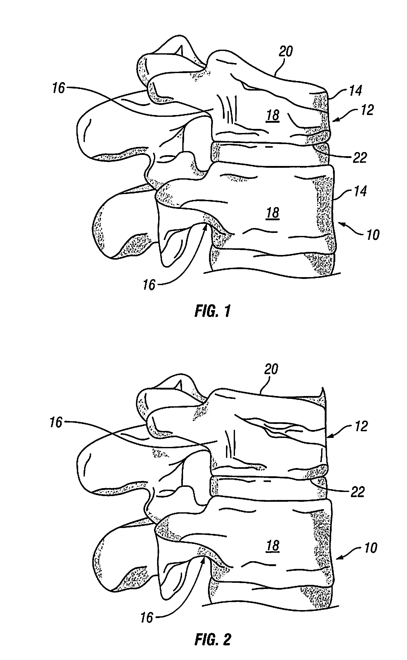 Devices and Methods for Treating Bone