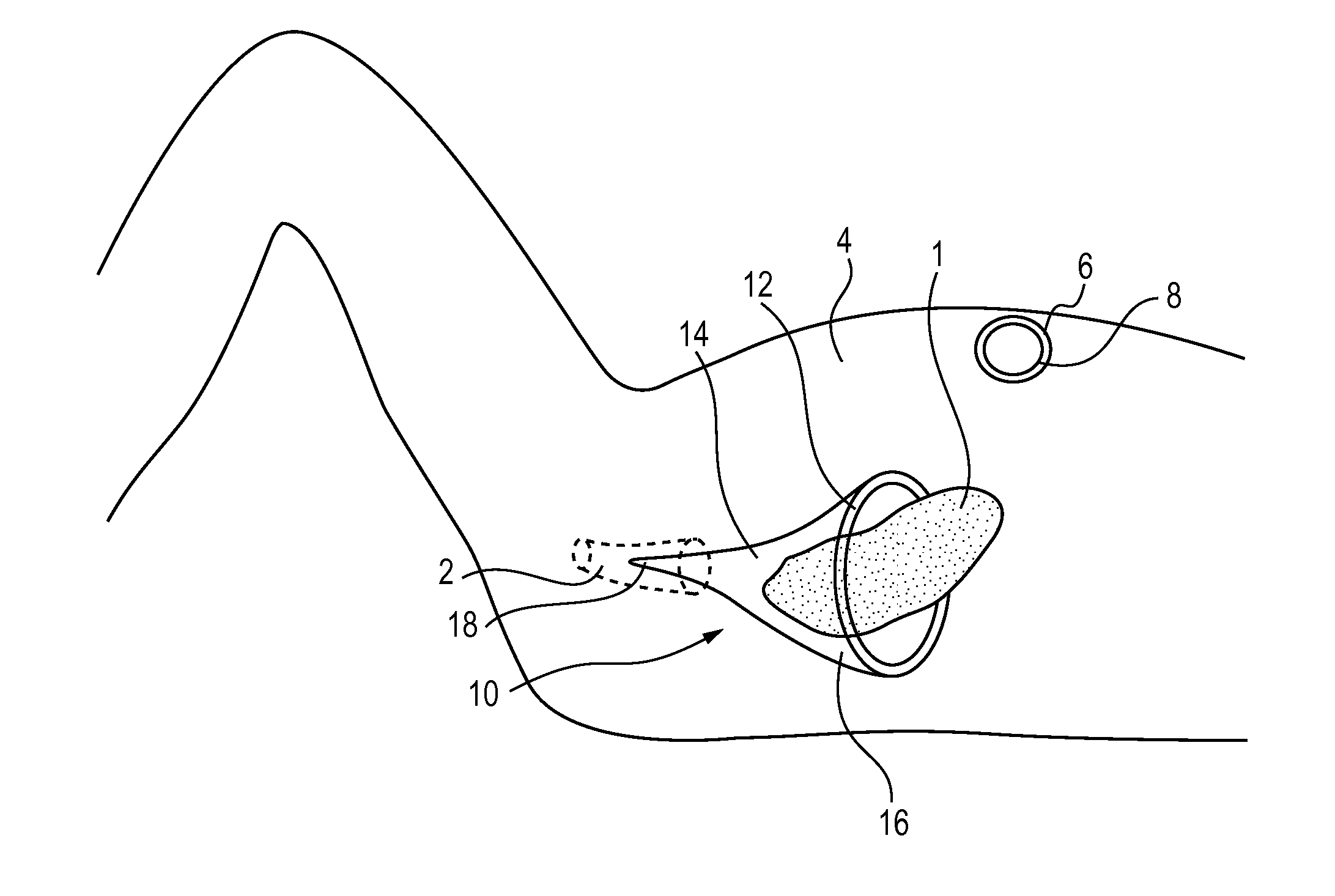 Methods for Isolating and Removing Tissue During a Female Patient's Laparoscopic Surgery