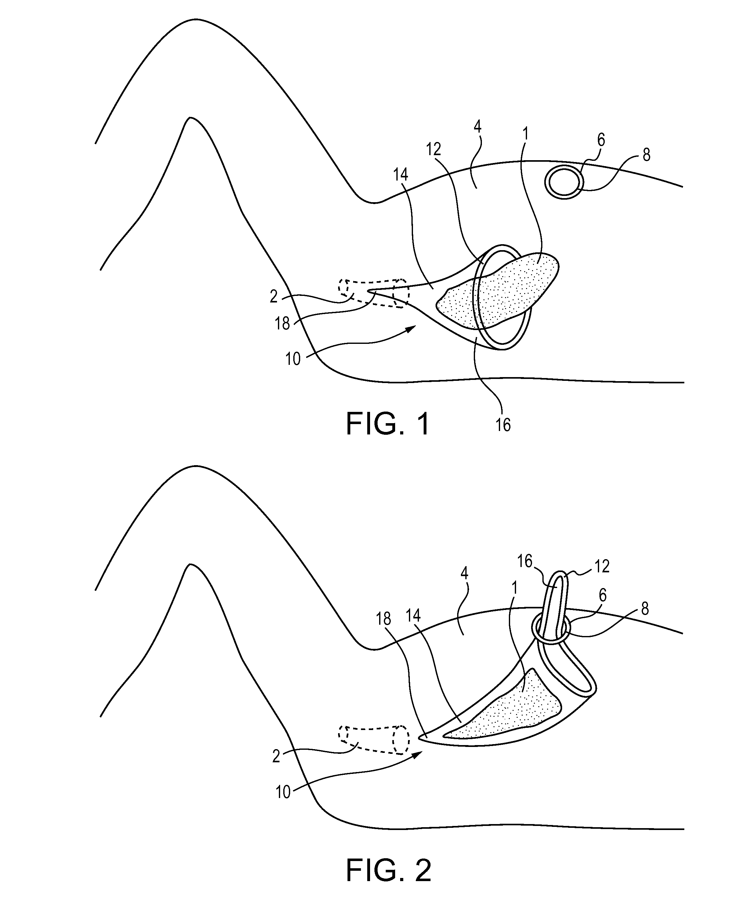 Methods for Isolating and Removing Tissue During a Female Patient's Laparoscopic Surgery