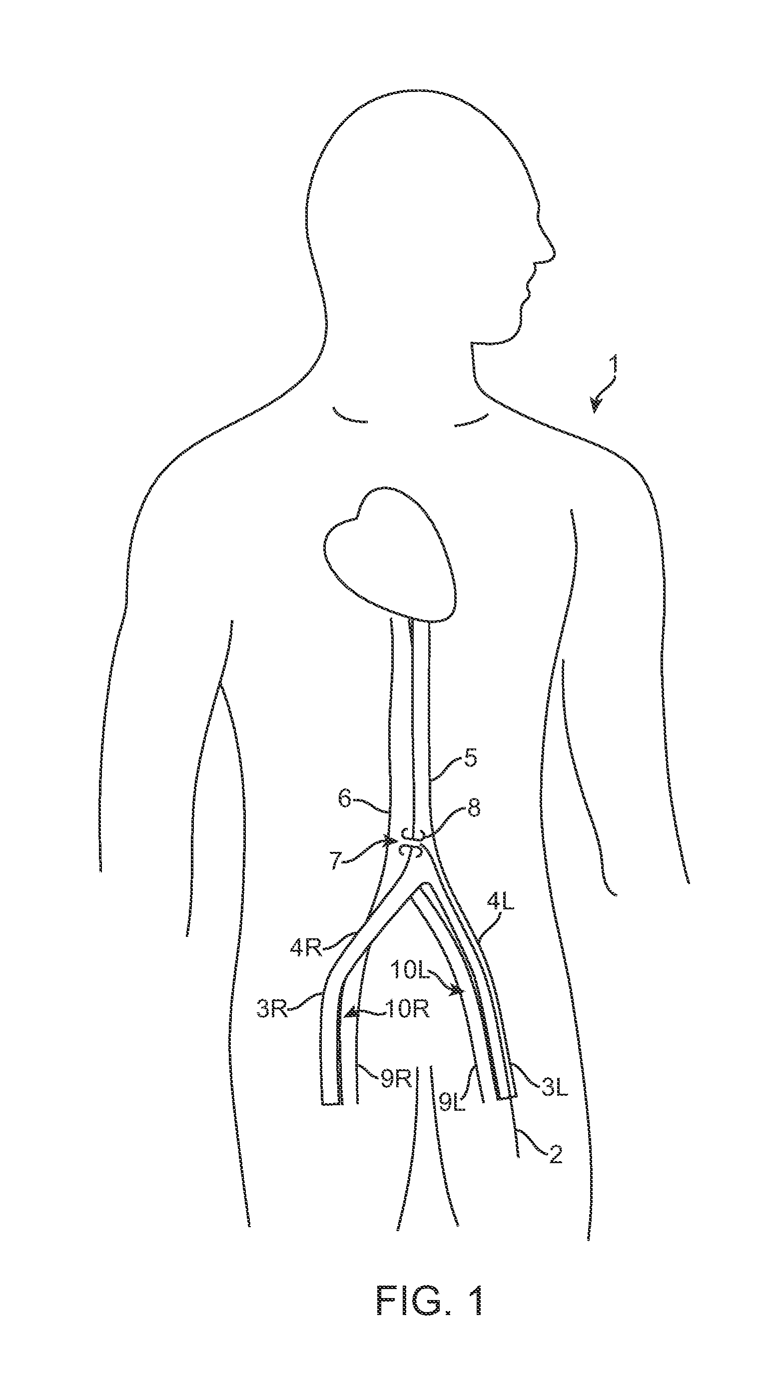 Device and method for establishing an artificial arterio-venous fistula