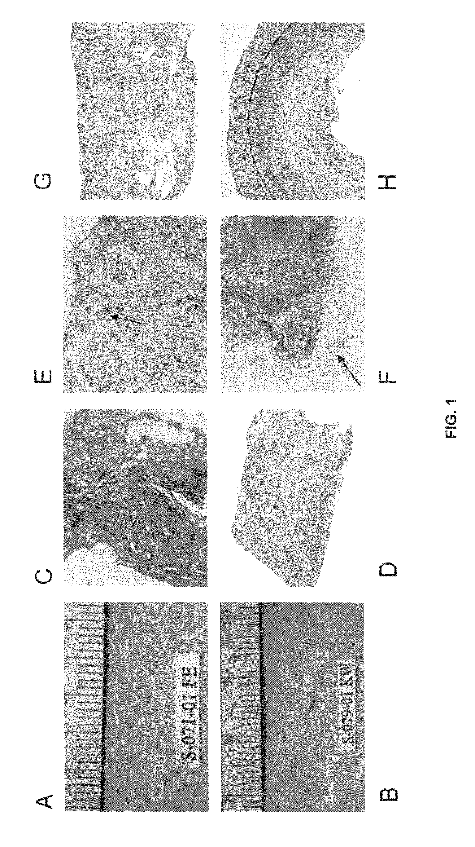 Genes associated with restenosis