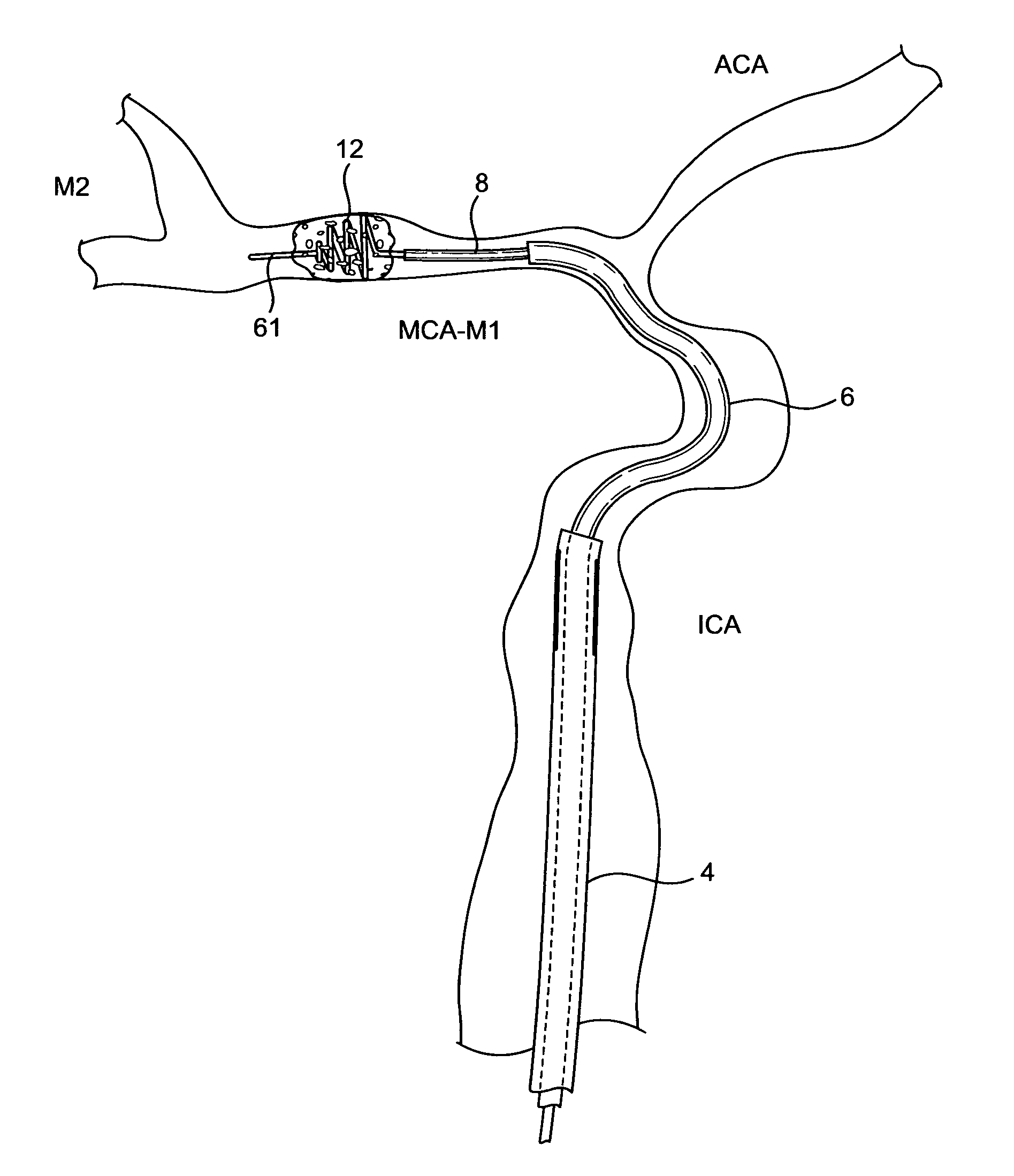 Devices and methods for accessing a cerebral vessel