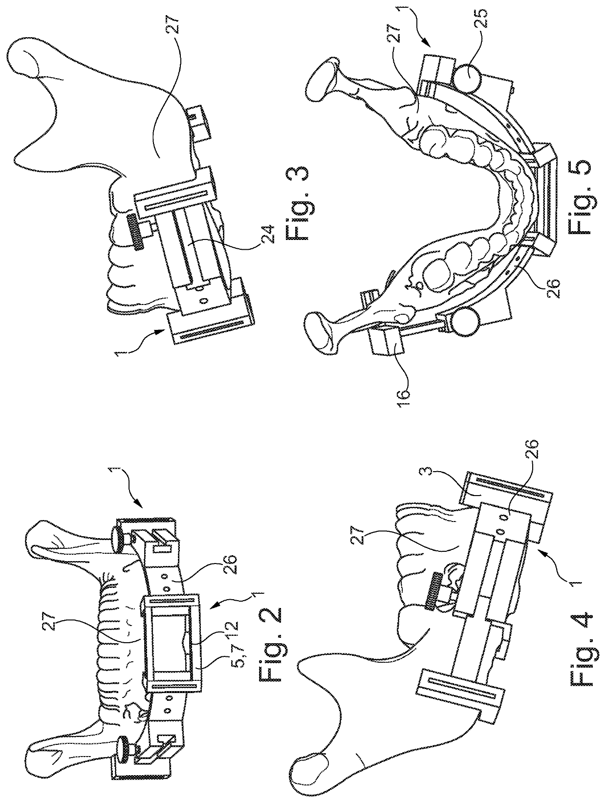 Fibula bone material removal and transfer template