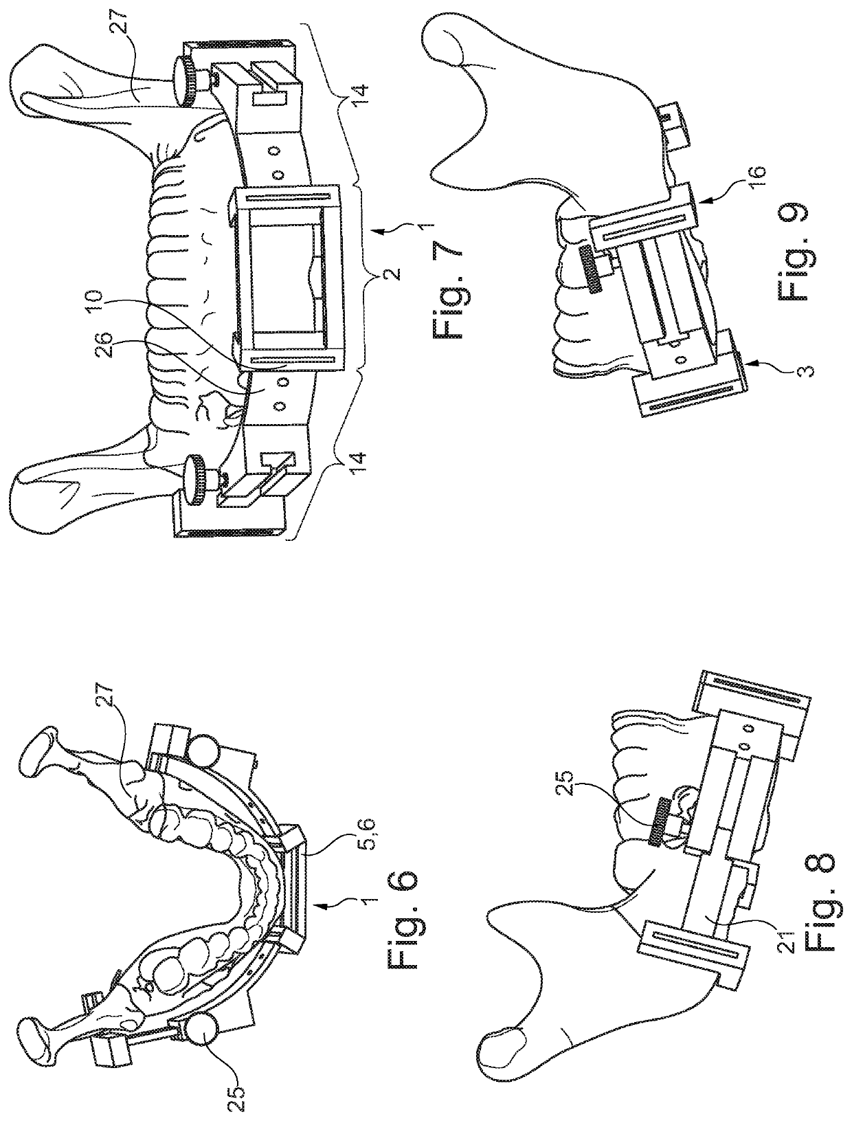 Fibula bone material removal and transfer template