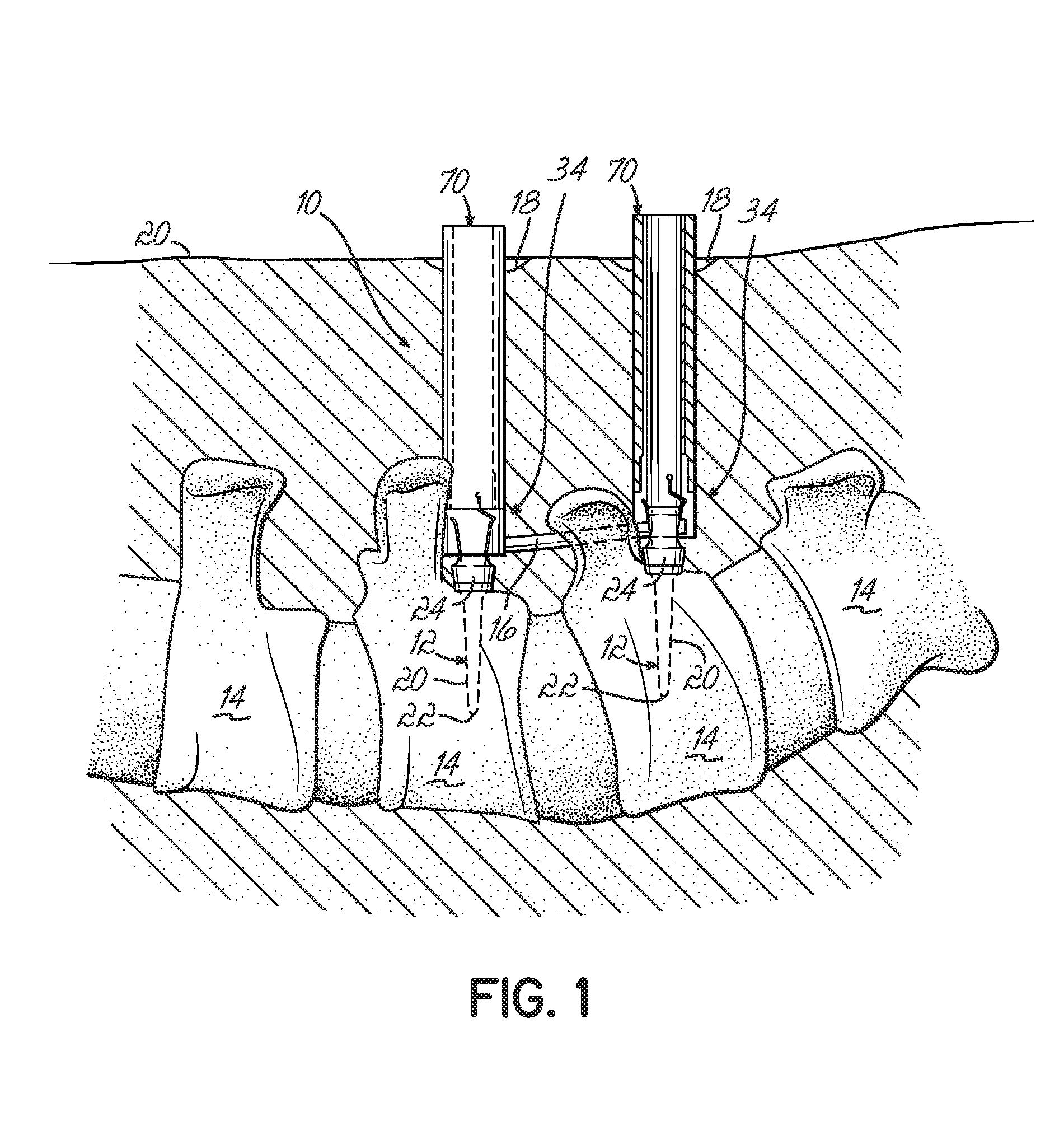 Minimally invasive vertebral anchor access system and associated method
