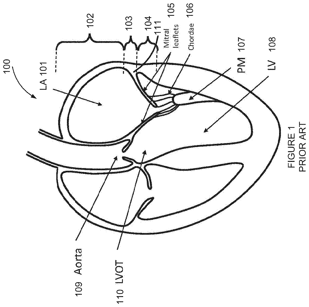 Multi-level cardiac implant