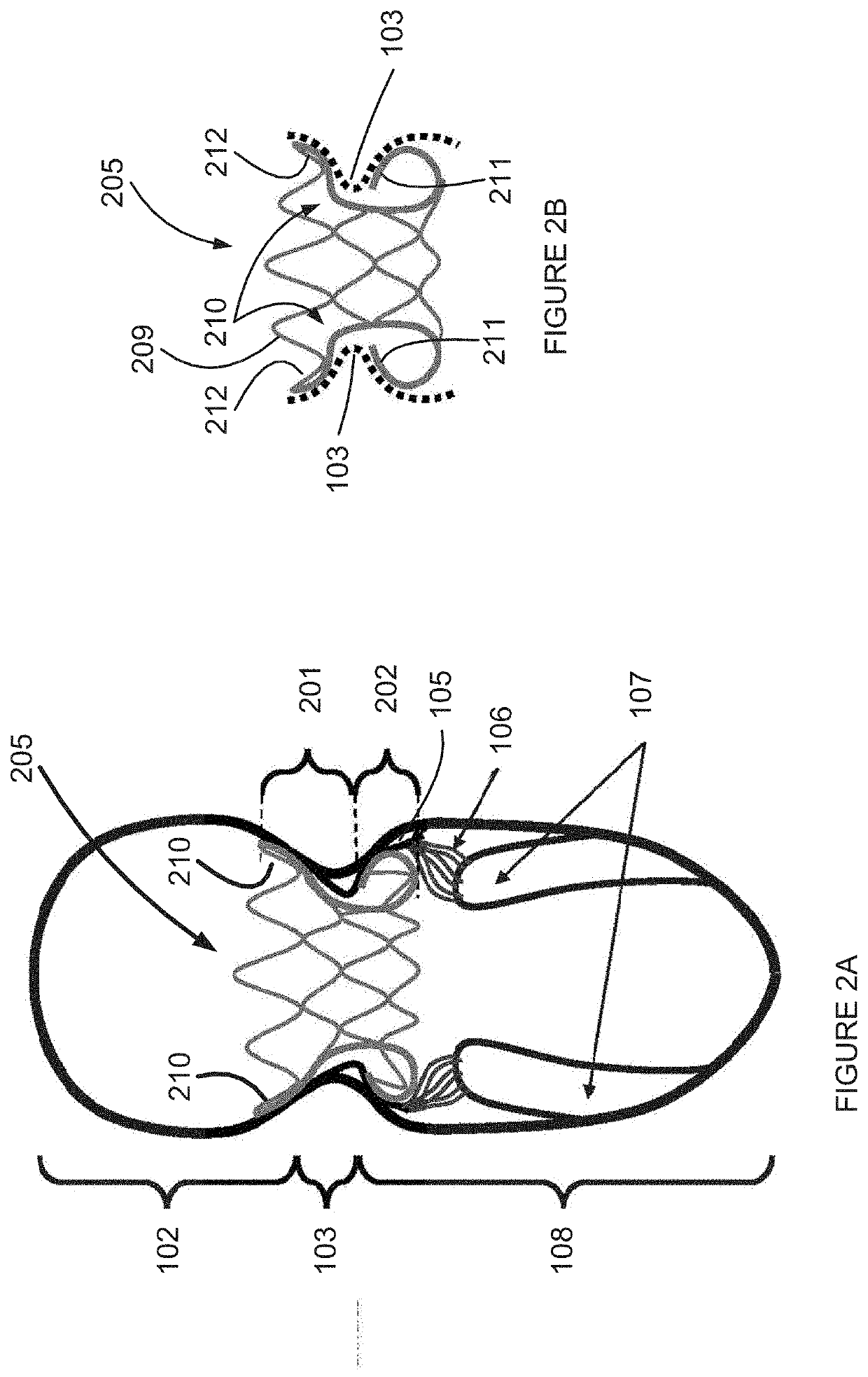 Multi-level cardiac implant