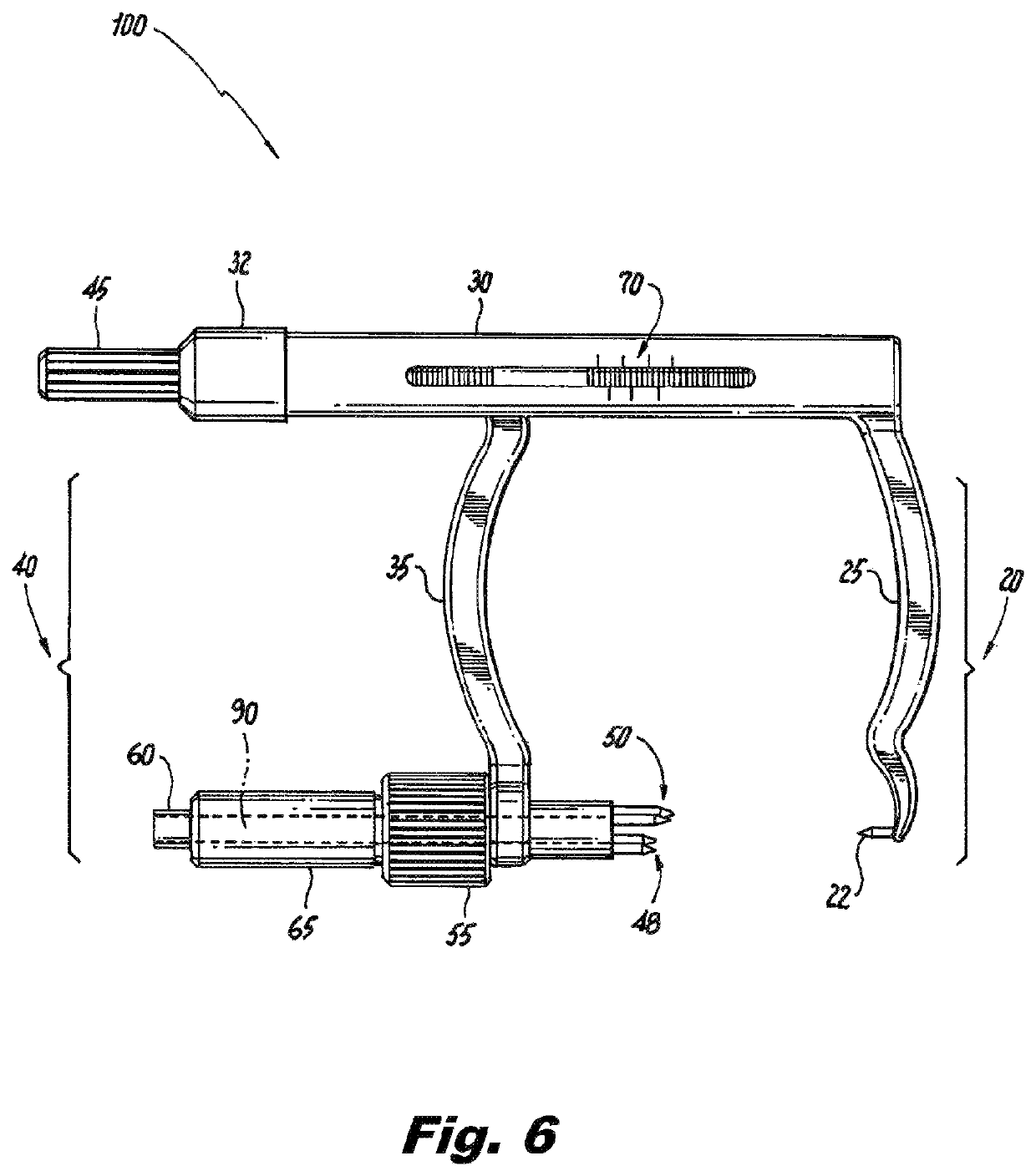 Methods, instruments and implants for scapho-lunate reconstruction