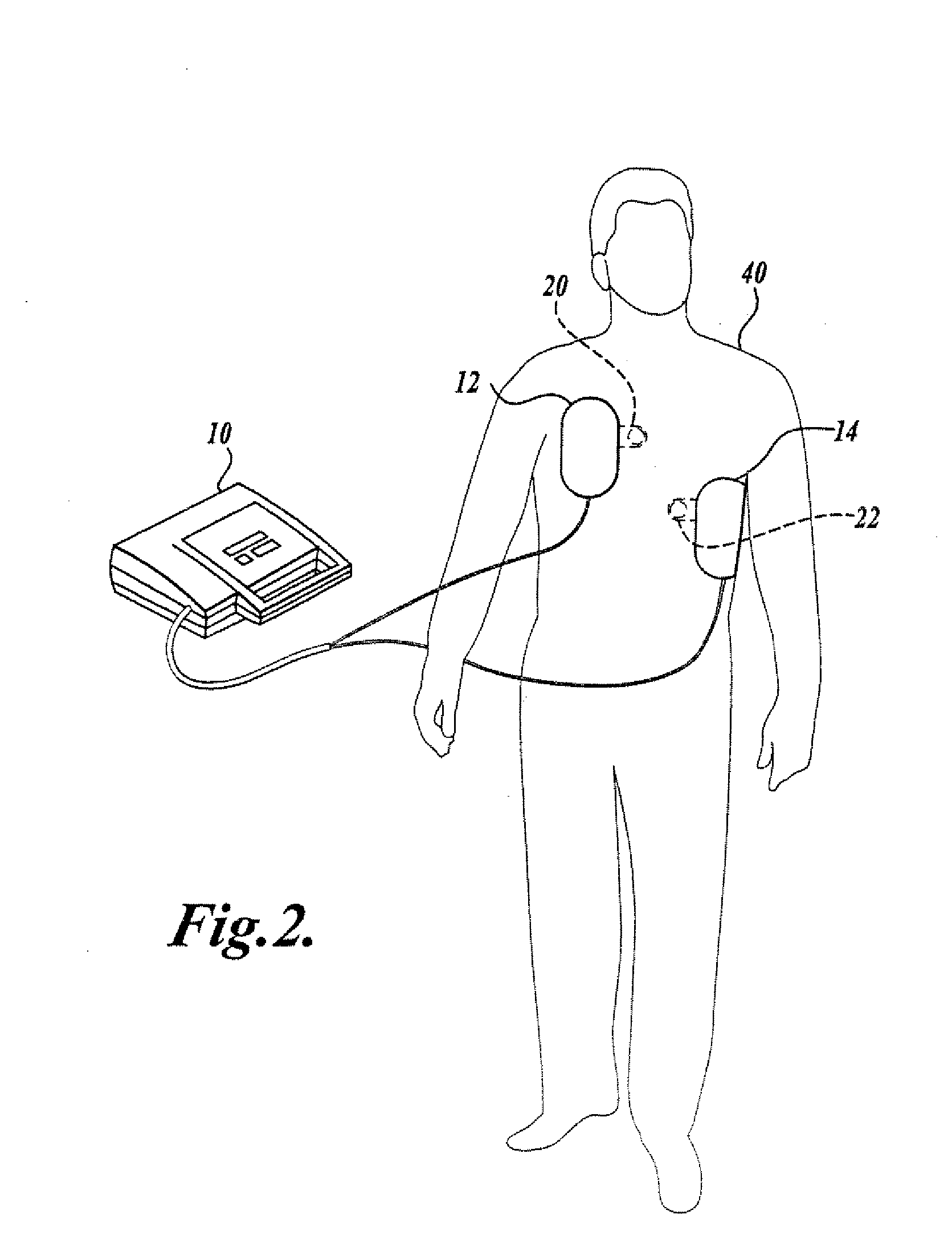 Pulse Detection Method and Apparatus Using Patient Impedance