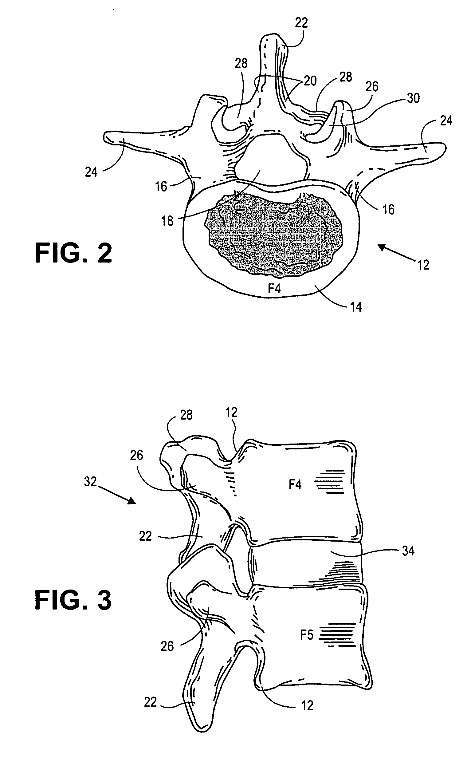 Prostheses, tools and methods for replacement of natural facet joints with artificial facet joint surfaces