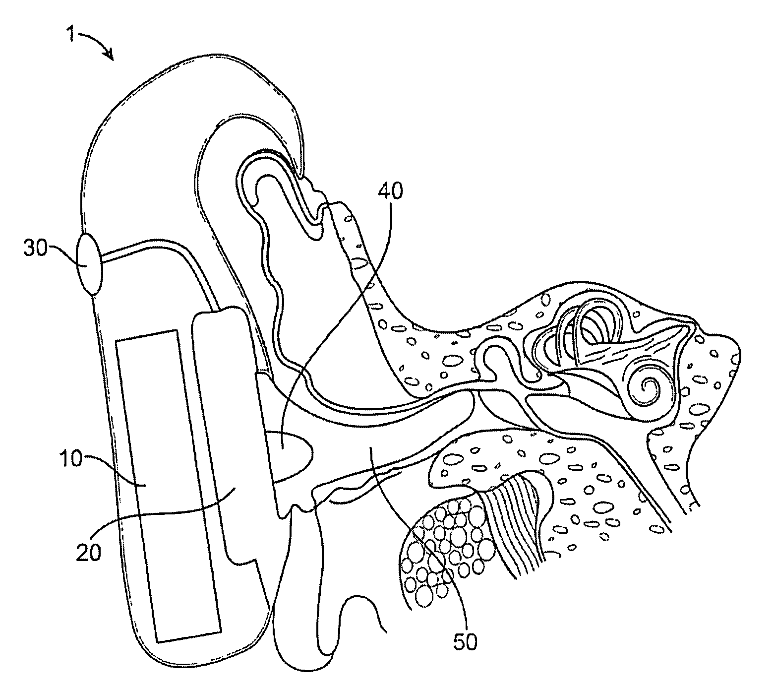 Optical ear infection treatment device and method
