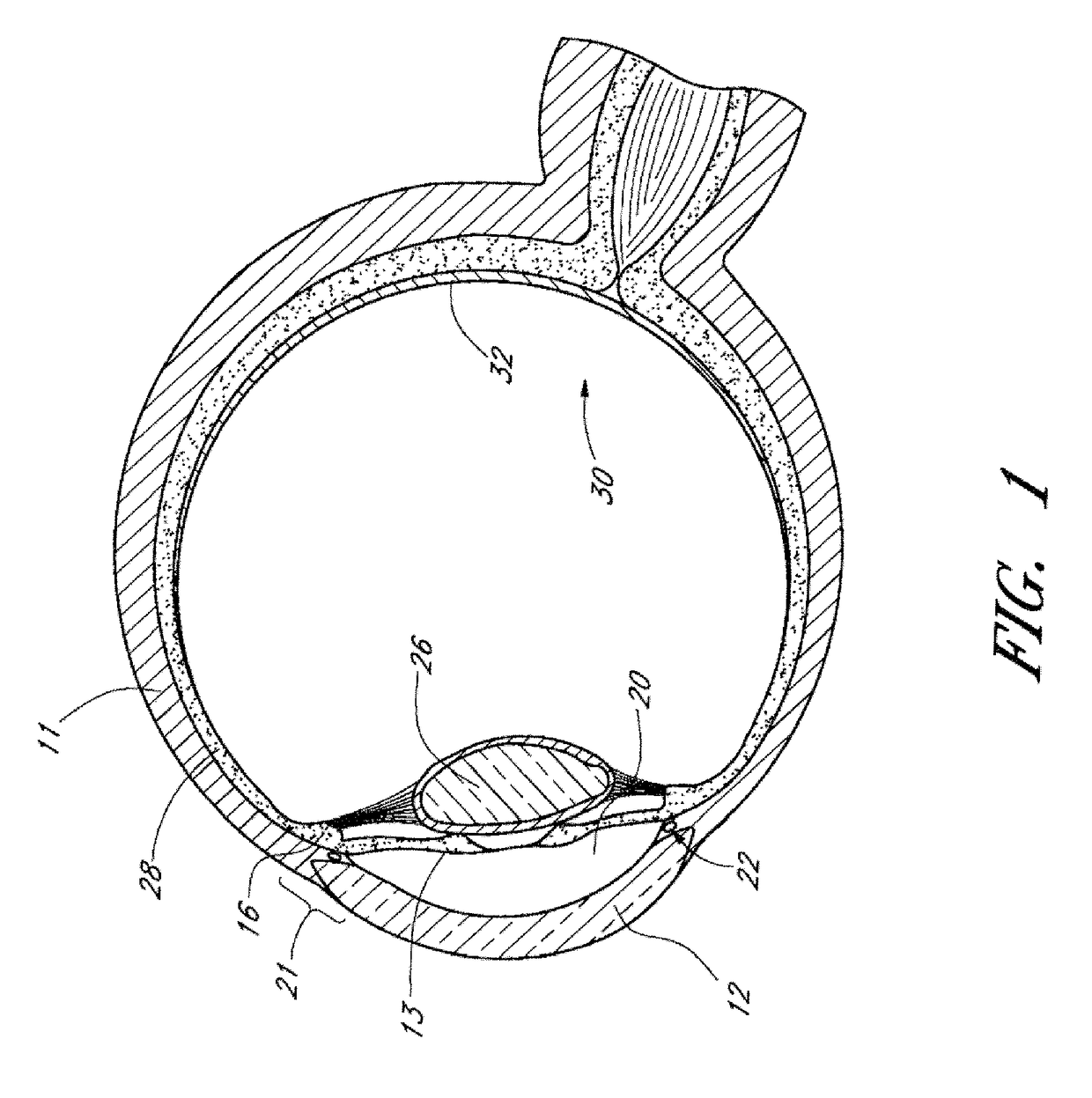 Drug delivery implants with bi-directional delivery capacity