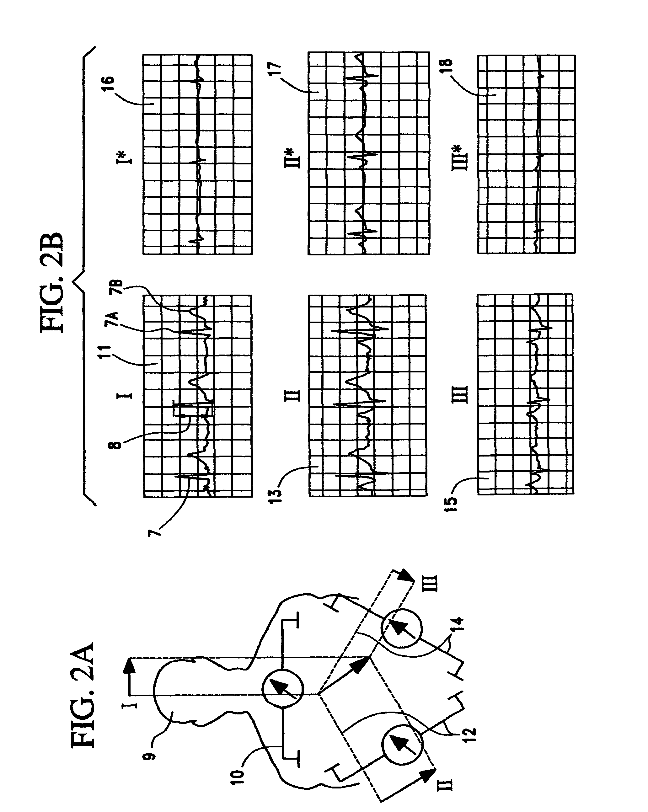 Method of vagal stimulation to treat patients suffering from congestive heart failure