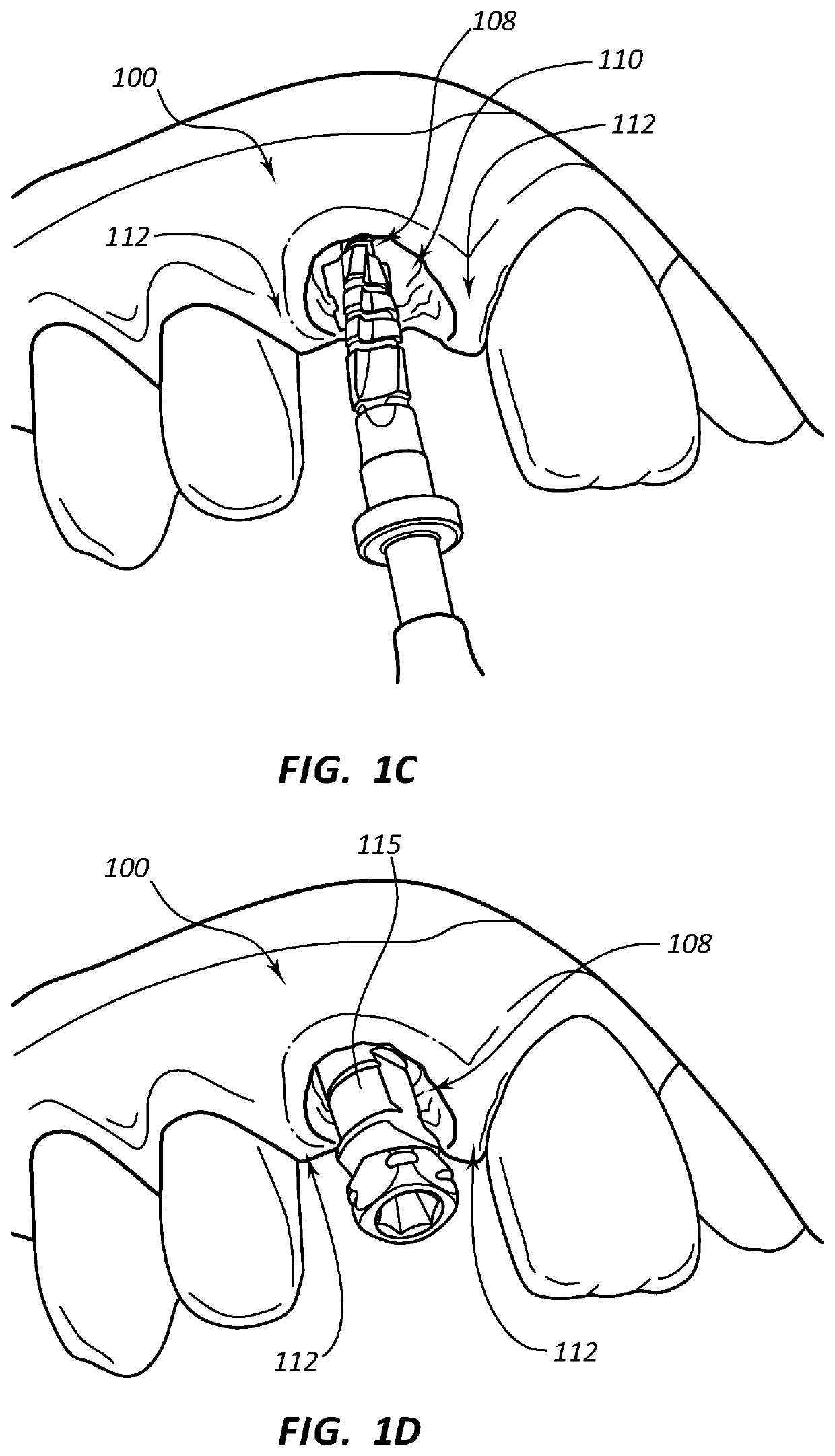 Dental implants with markers for determining three-dimensional positioning