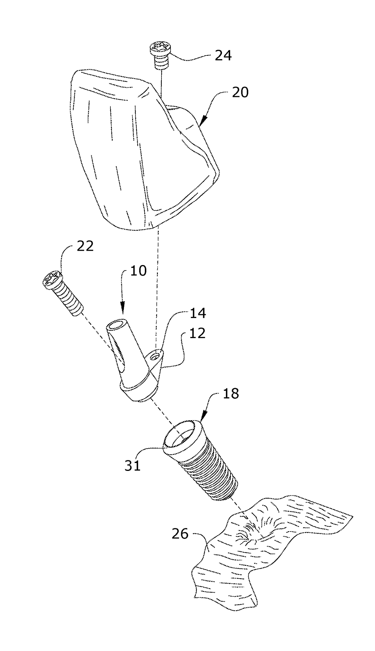 System, method and apparatus for cementless retention of dental crowns to implants