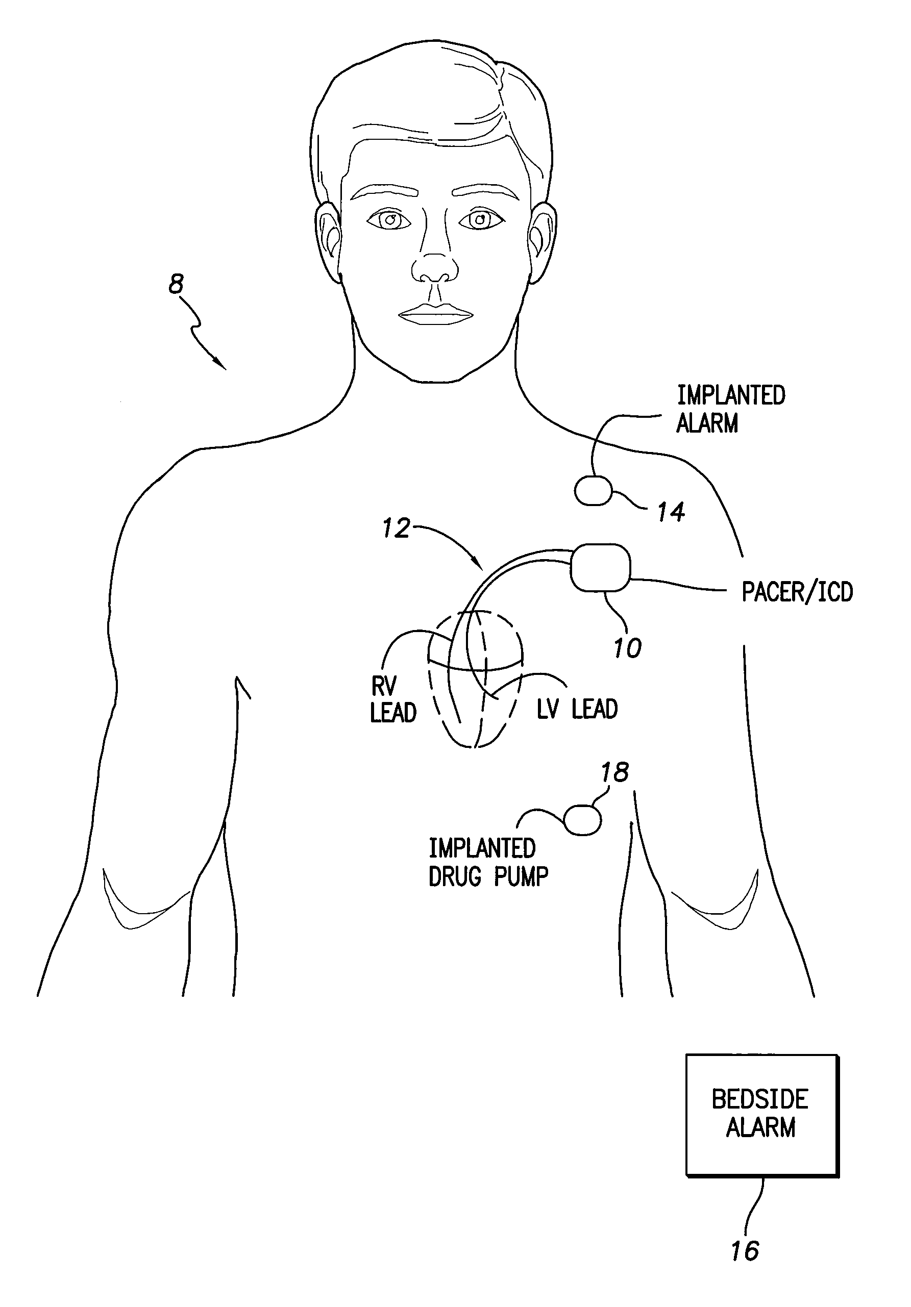 Systems and methods for detecting and compensating for changes in posture during ischemia detection a using an implantable medical device