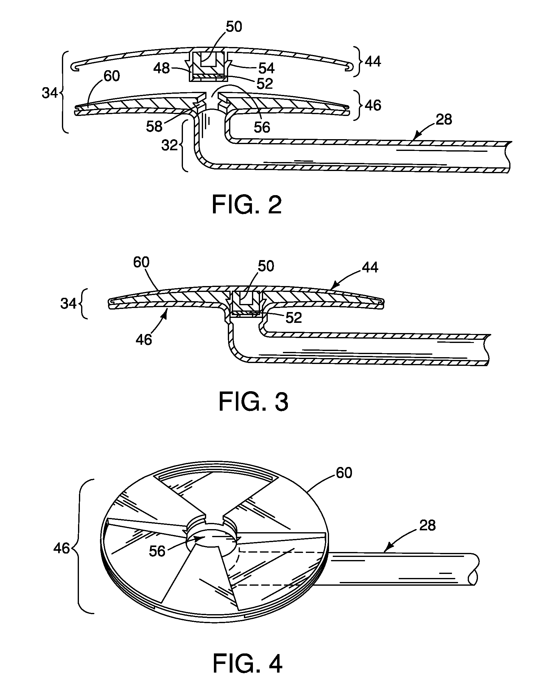 Method and apparatus for reducing intraocular pressure