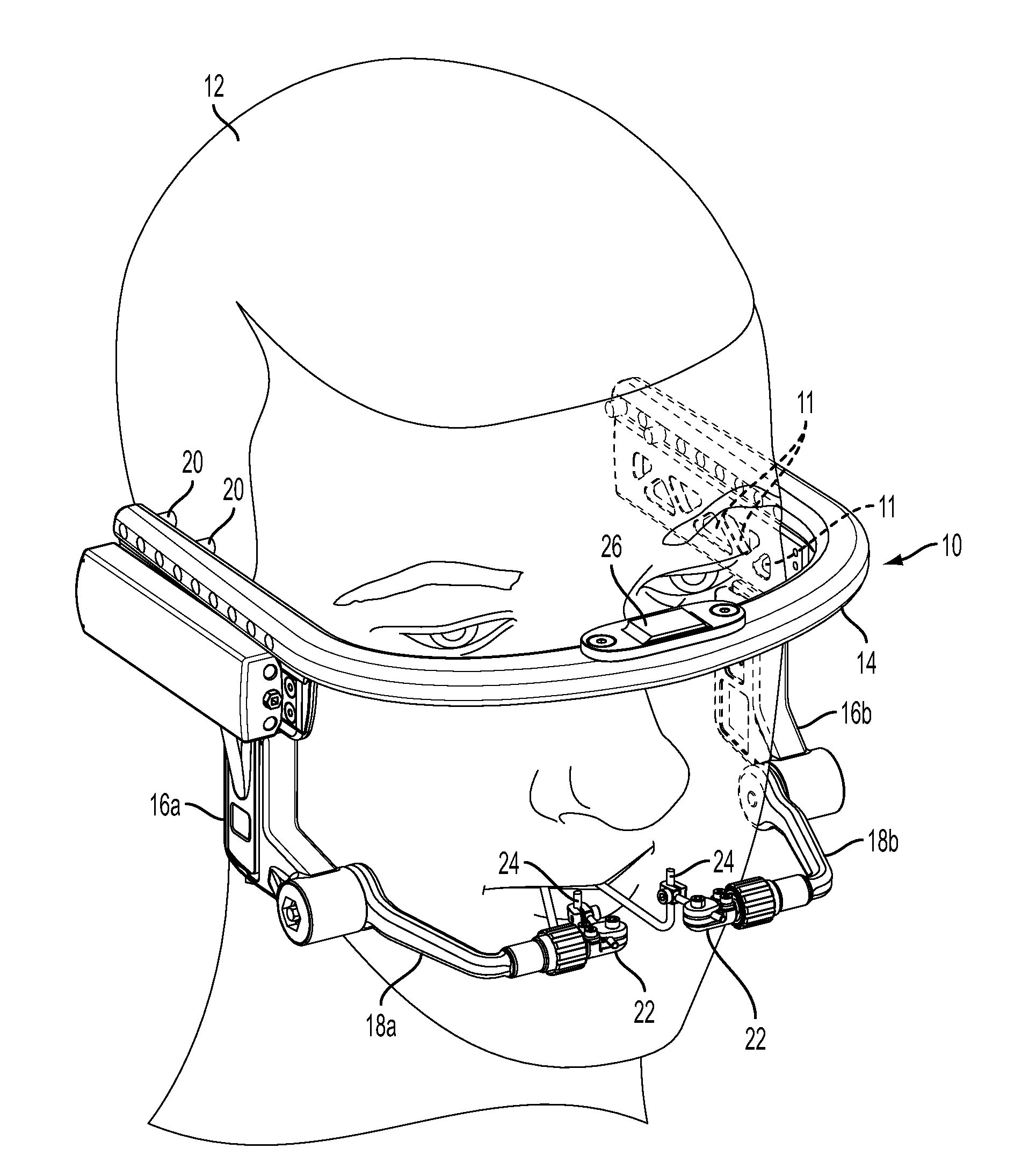 Craniofacial External Distraction Apparatus