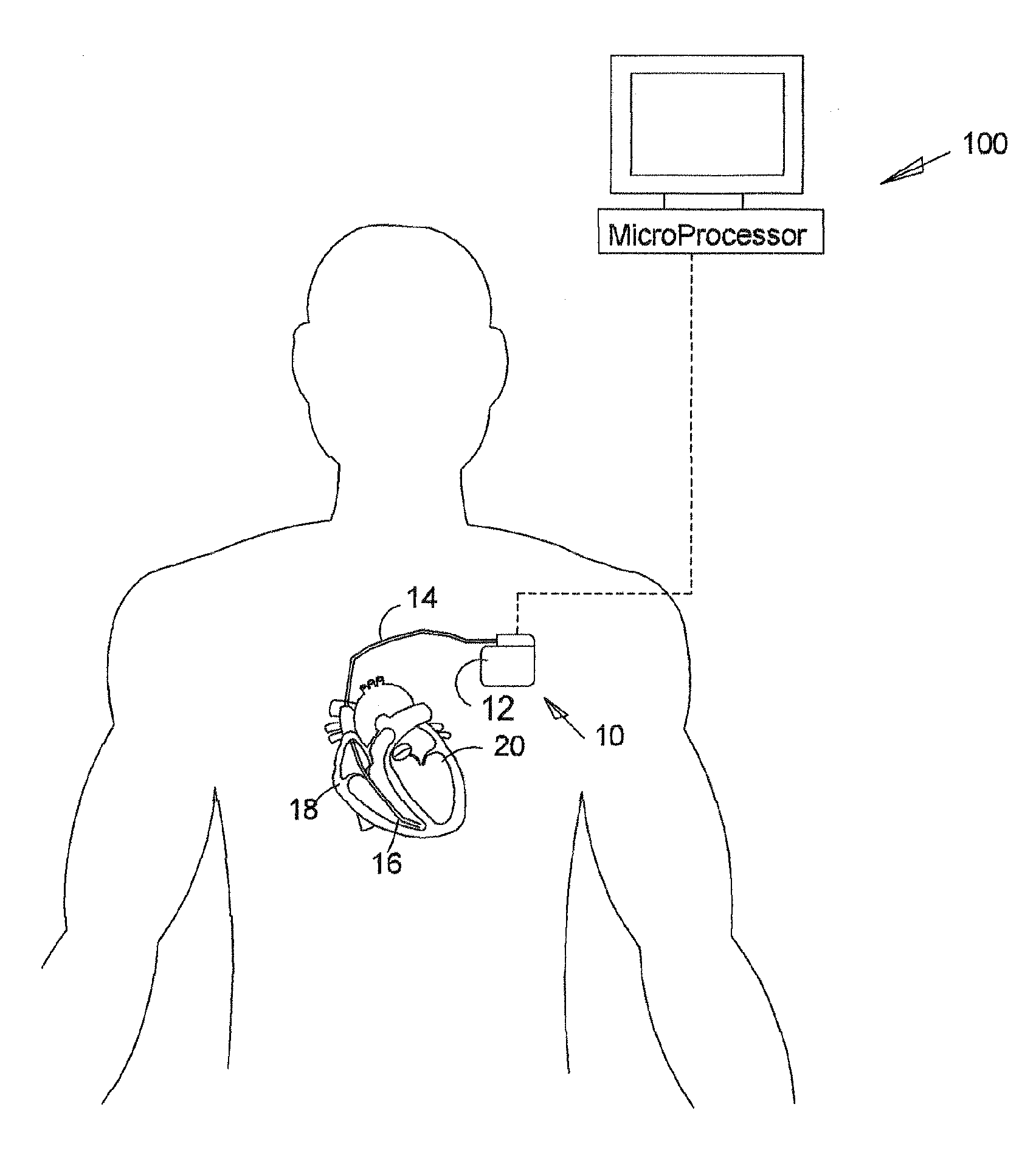 Cardiac pacemaker with loss of atrial capture mode switching and method