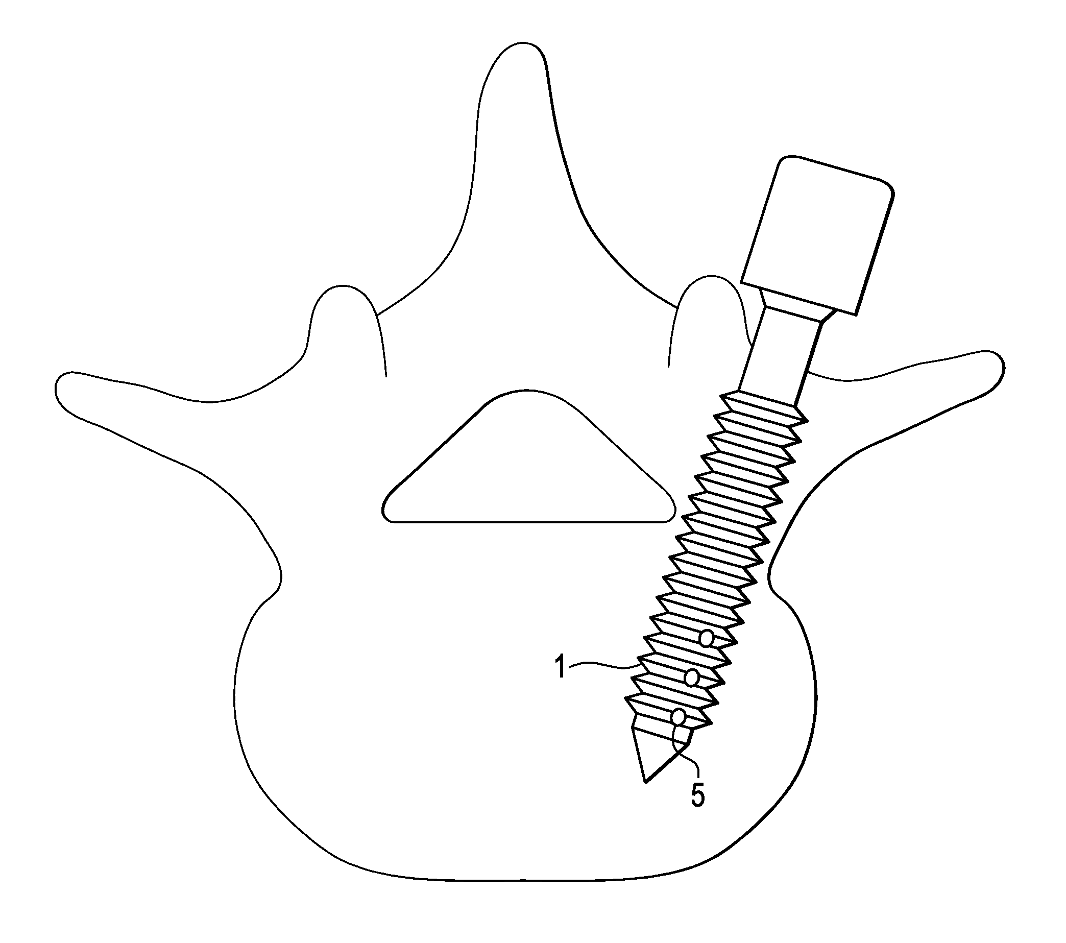 Methods and Devices for Correcting Spinal Deformity With Pharmaceutical-Eluting Pedicle Screws